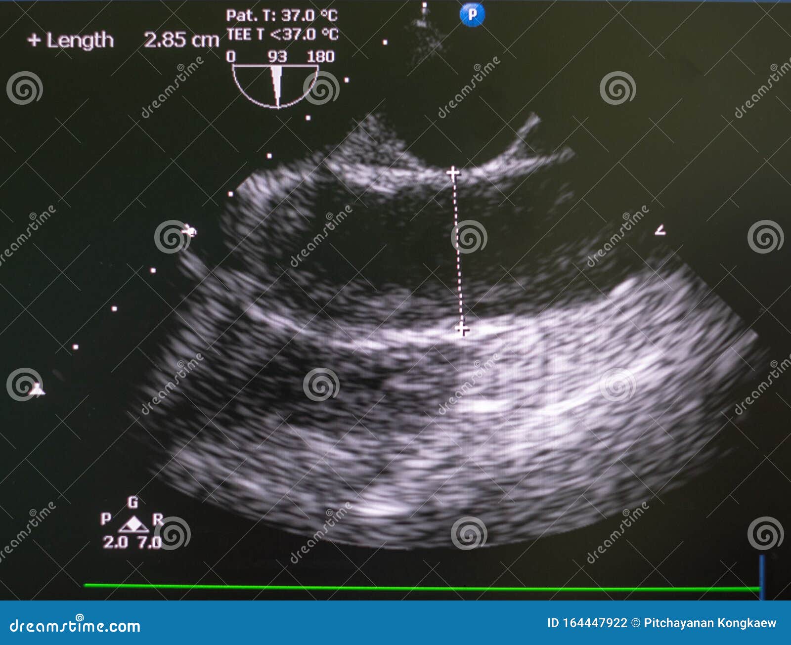 Echocardiography Ultrasound Machine. Stock Photo - Image of ascending