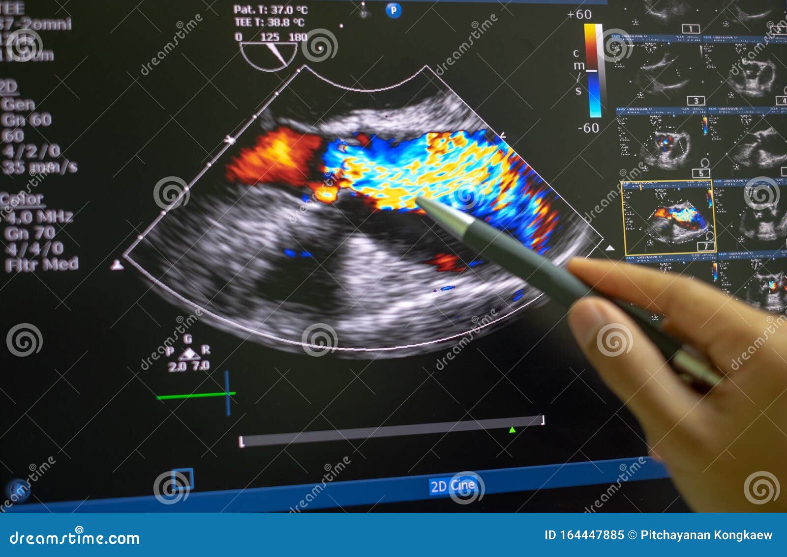 Echocardiography, Ultrasound Of The Heart. Normal Children`s Result Of