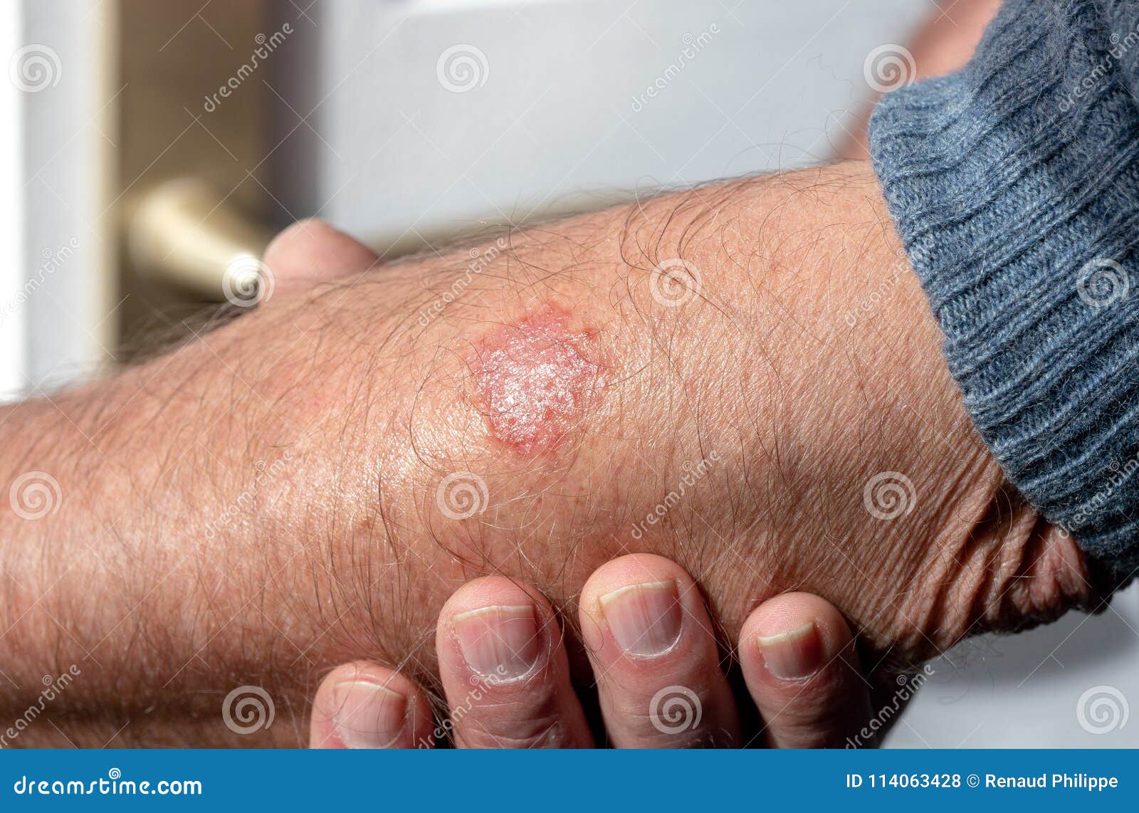 eczema on the arm of a man