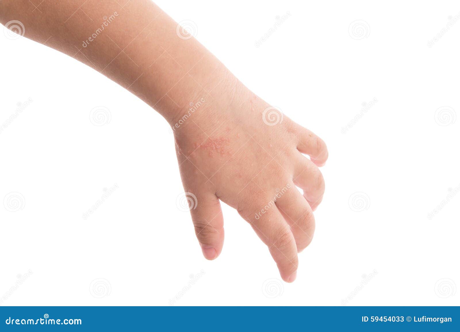 Eczema on baby s hand stock image. Image of asian, psoriasis 59454033