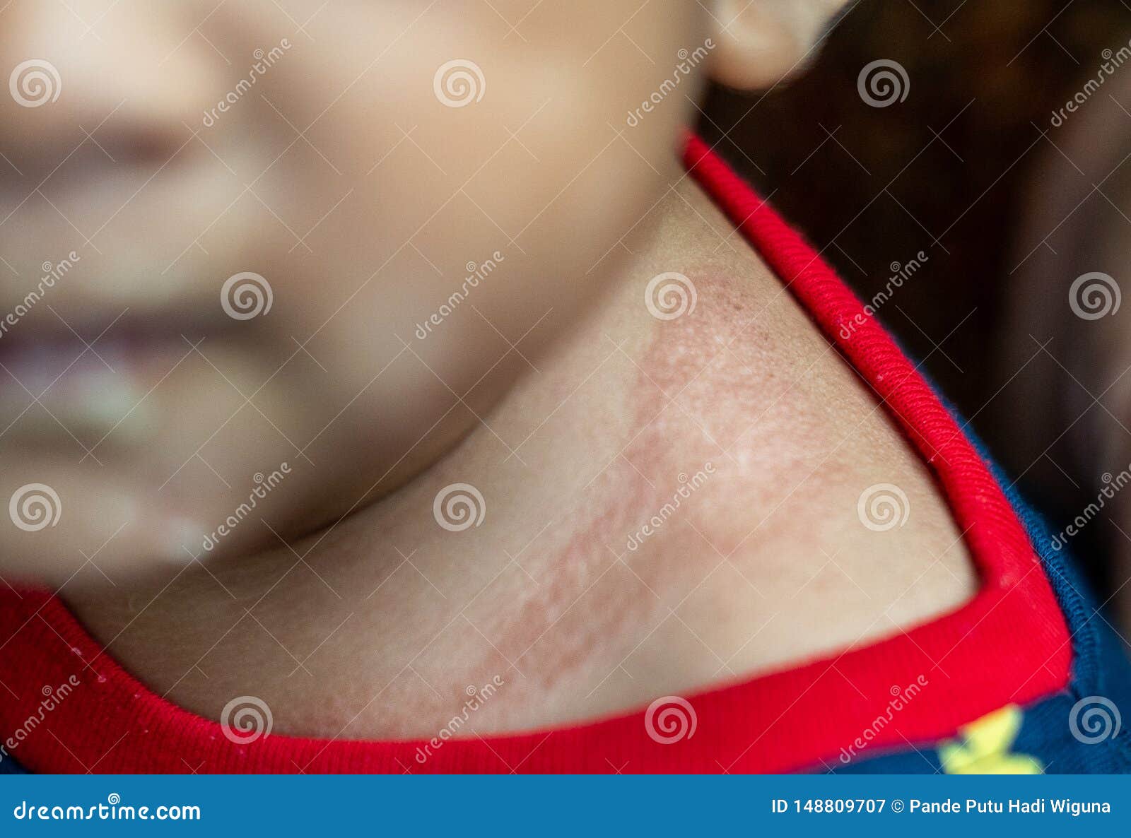 eczema can show up as red, crusty patches on your baby`s skin, often during their first few months. itÃ¢â¬â¢s common and very
