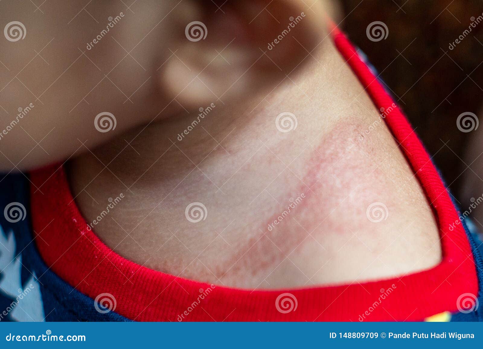 eczema can show up as red, crusty patches on your baby`s skin, often during their first few months. itÃ¢â¬â¢s common and very