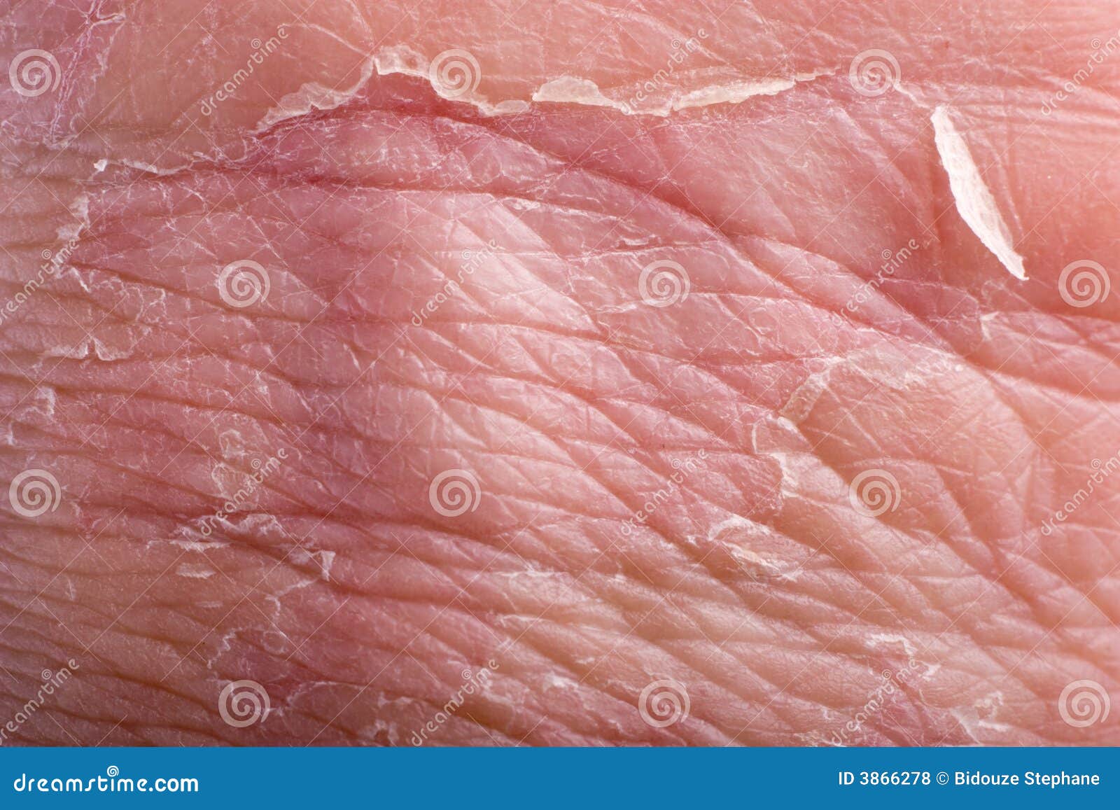 Eczema Closeup Royalty Free Stock Photos Image 3866278