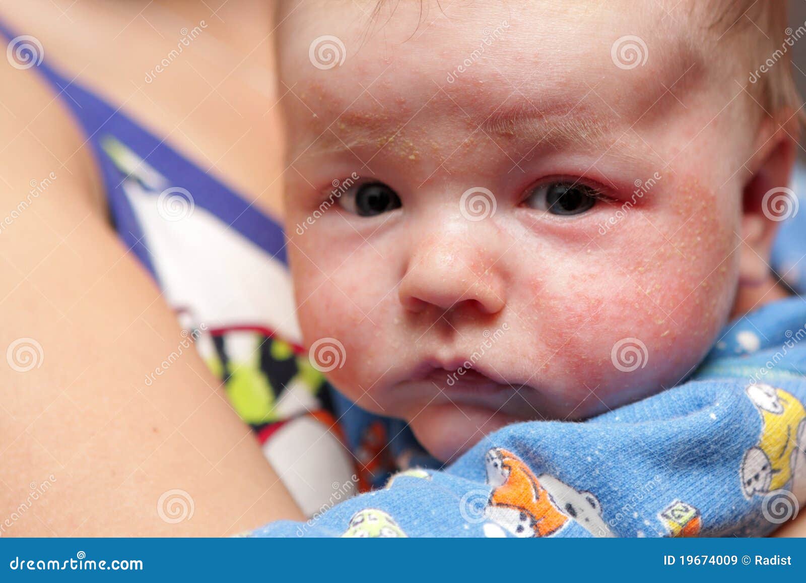 eczema on face of newborn
