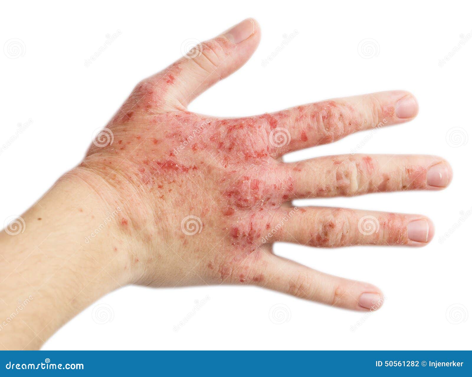 Atopic Dermatitis. Red, Itchy Hands With Blisters Seen By A