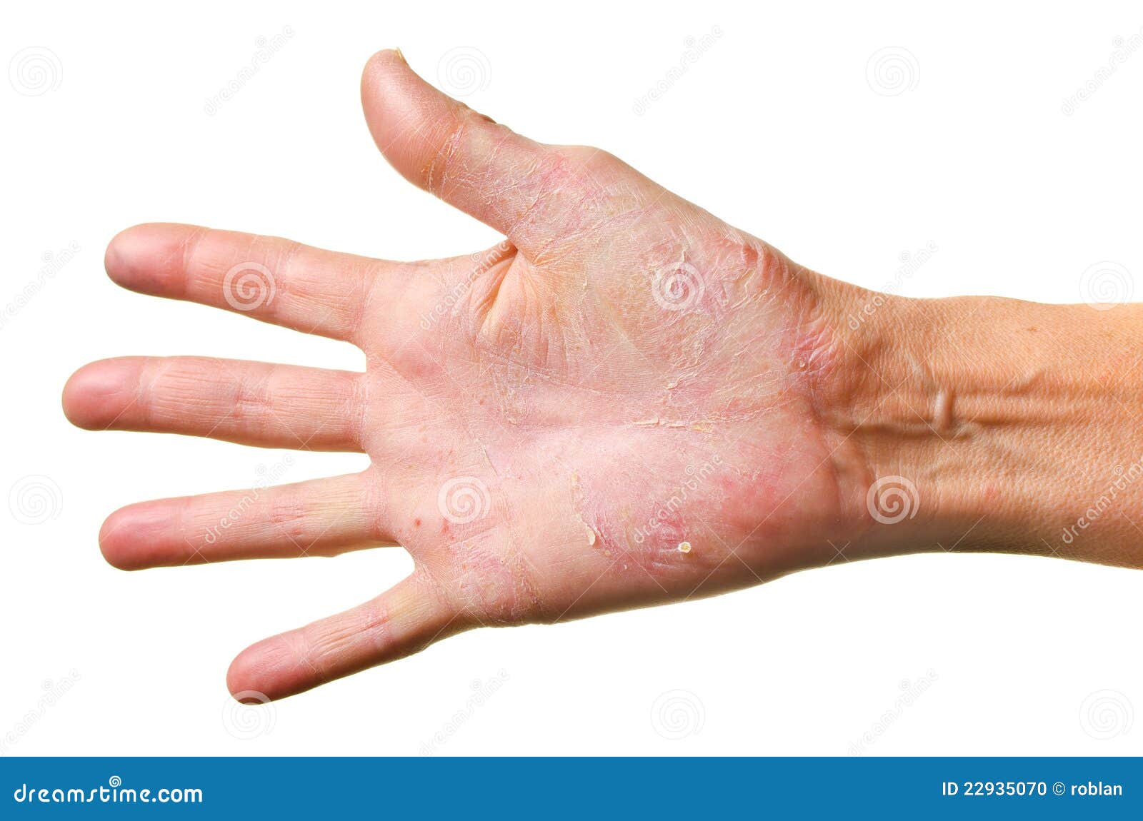 Eczema On A Hand Stock Photo Image Of Dermatitis Problem 22935070