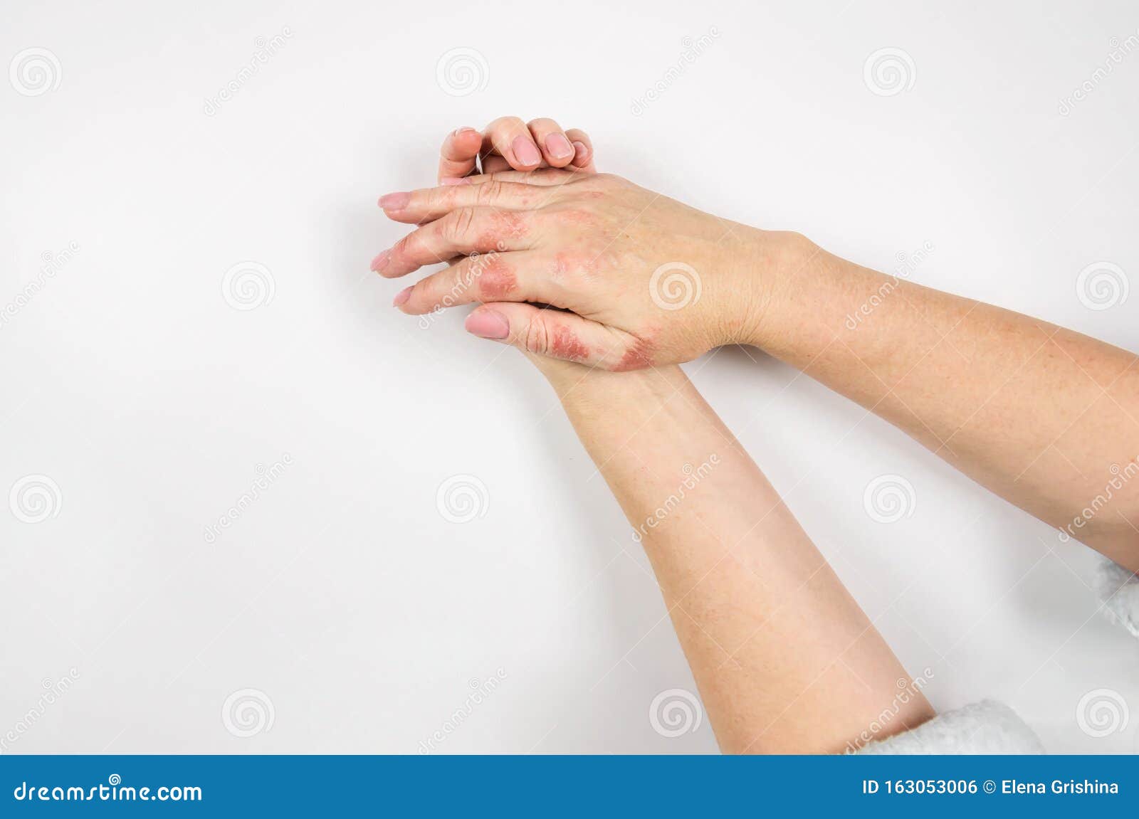 causes of closed hands causes of closed hands