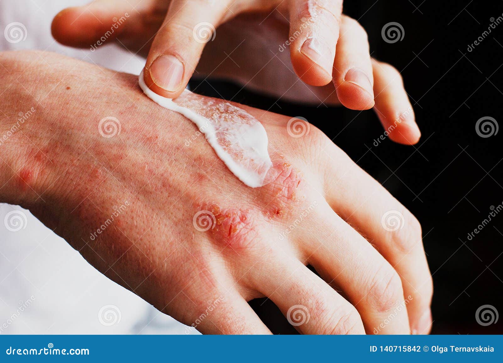 eczema on the hands. the man applying the ointment , creams in the treatment of eczema, psoriasis and other skin