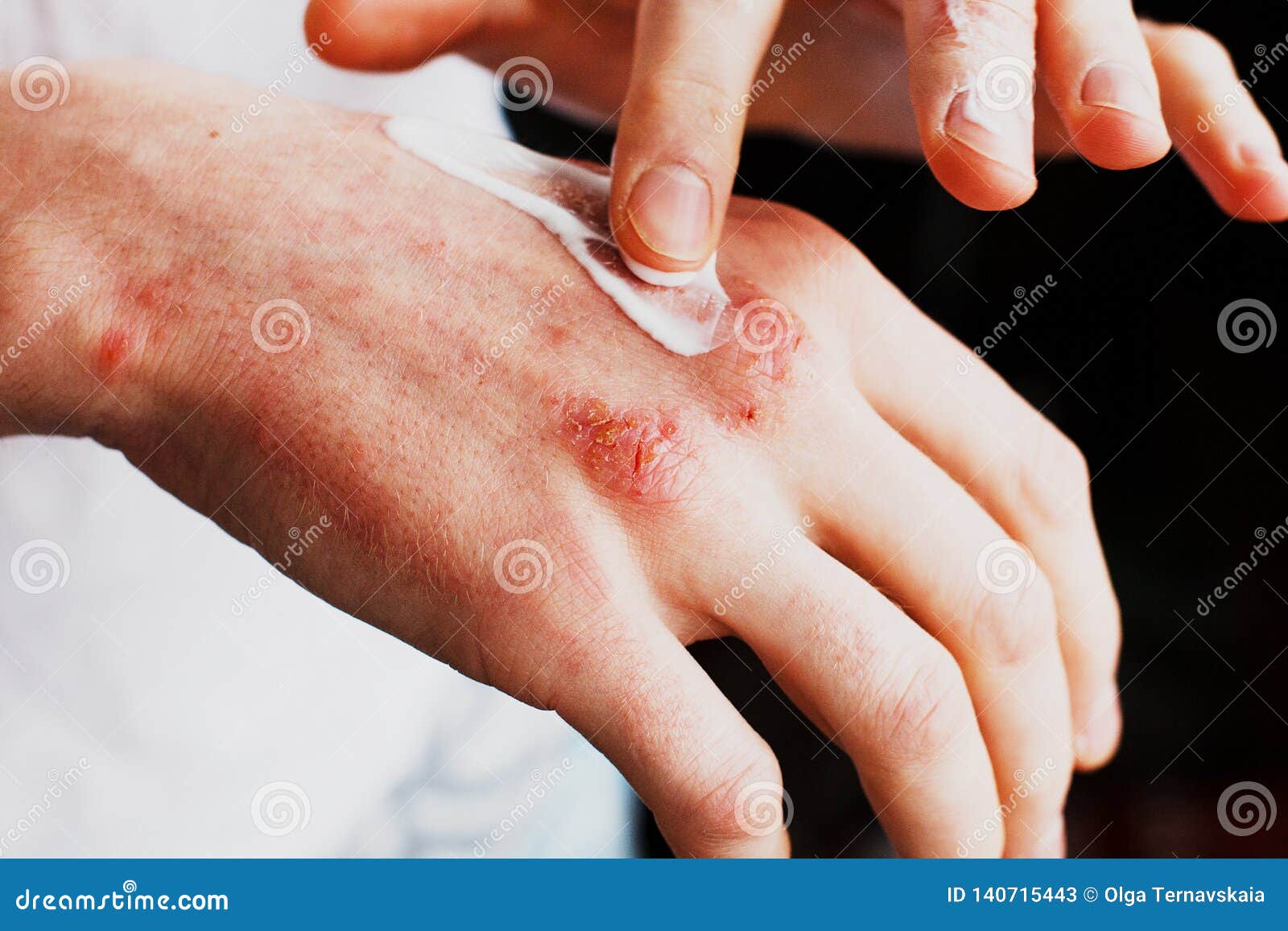eczema on the hands. the man applying the ointment , creams in the treatment of eczema, psoriasis and other skin