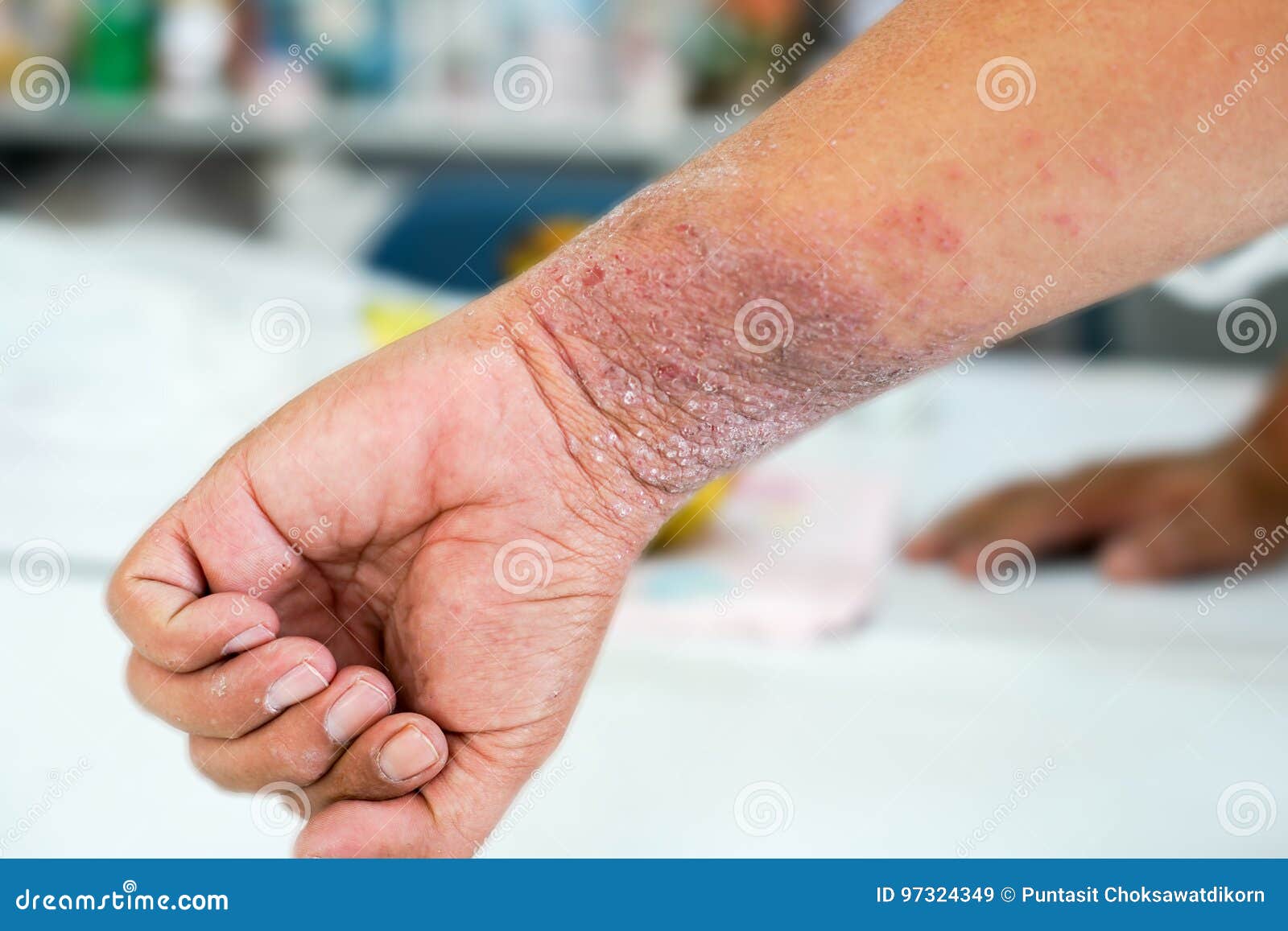 eczema presents on the hand