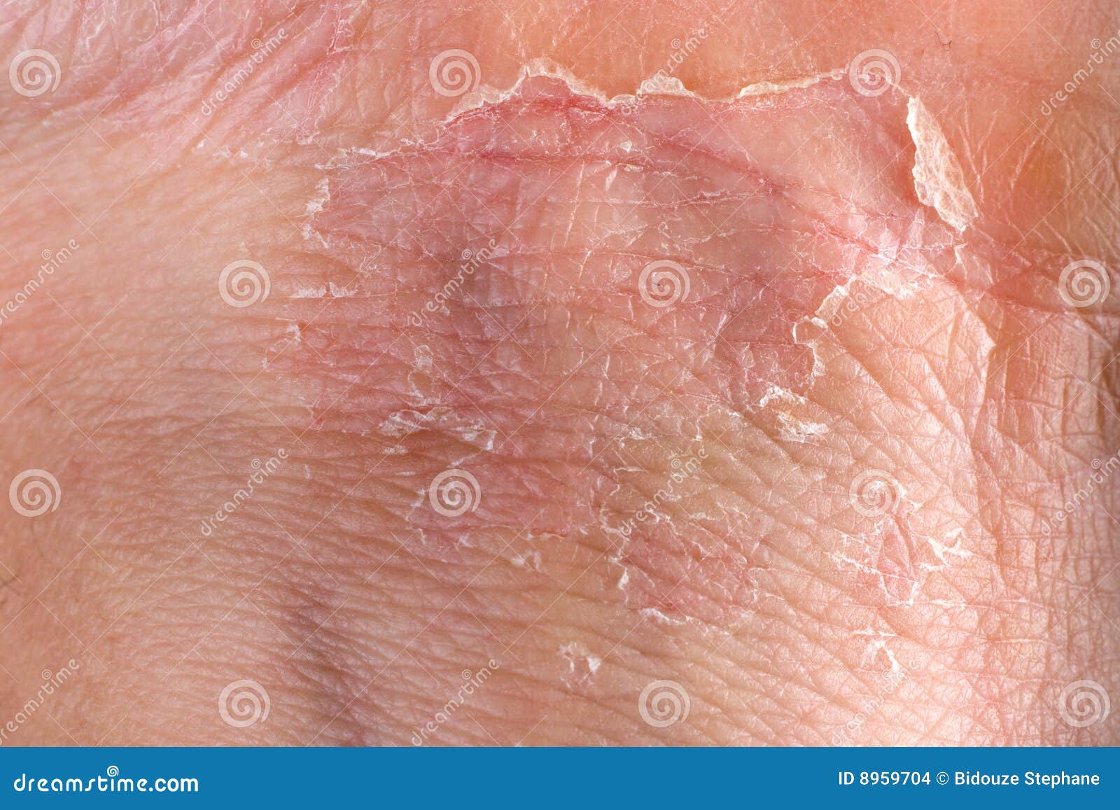 eczema on skin