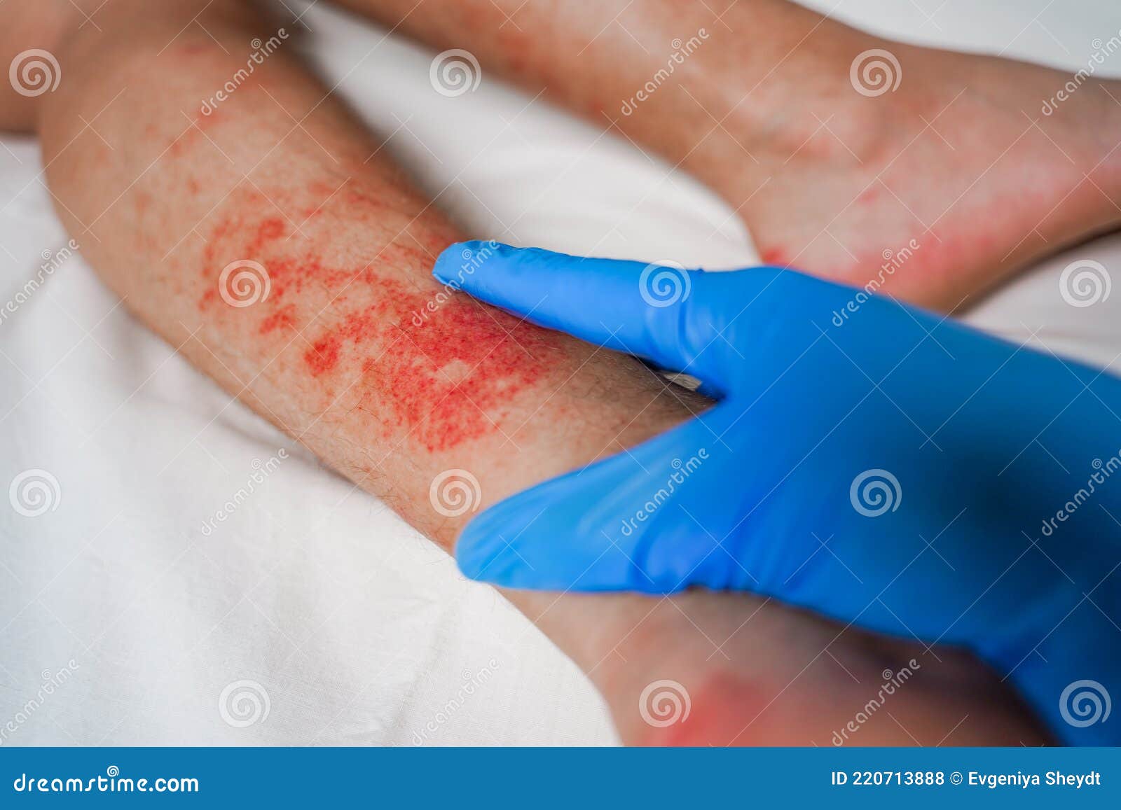 Eczema Skin Disease On The Legs Itchy Red Rashes And Spots Stock Photo