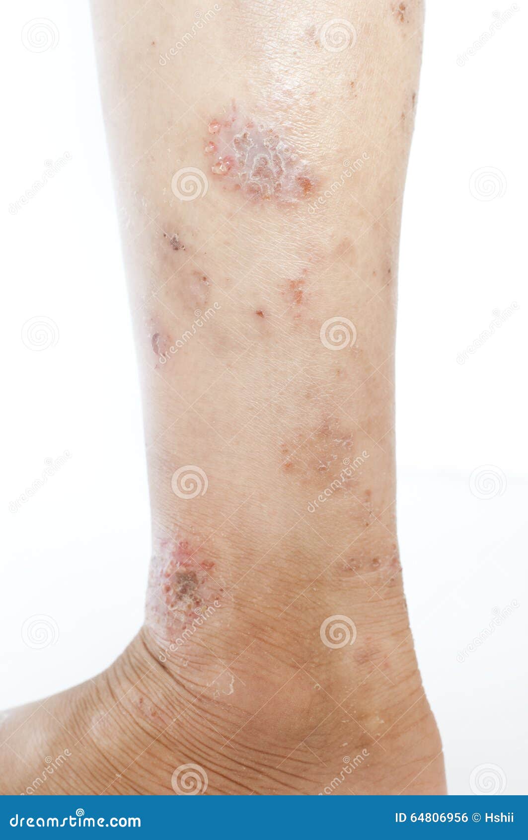 Eczema sulla gamba fotografia stock. Immagine di irritabile 64806956