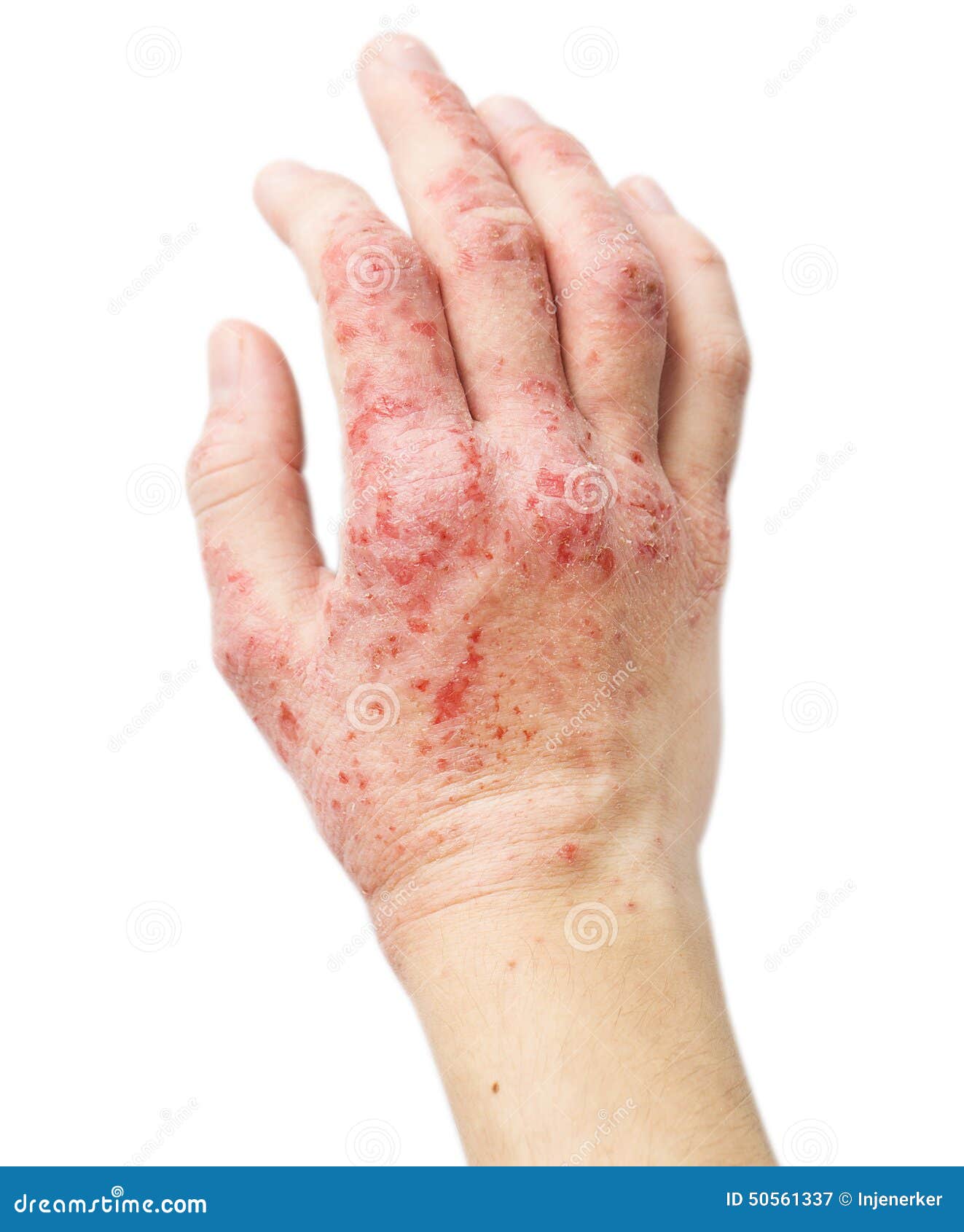 Eczema Sur Une Main Femelle Image stock Image du closeup, médecine