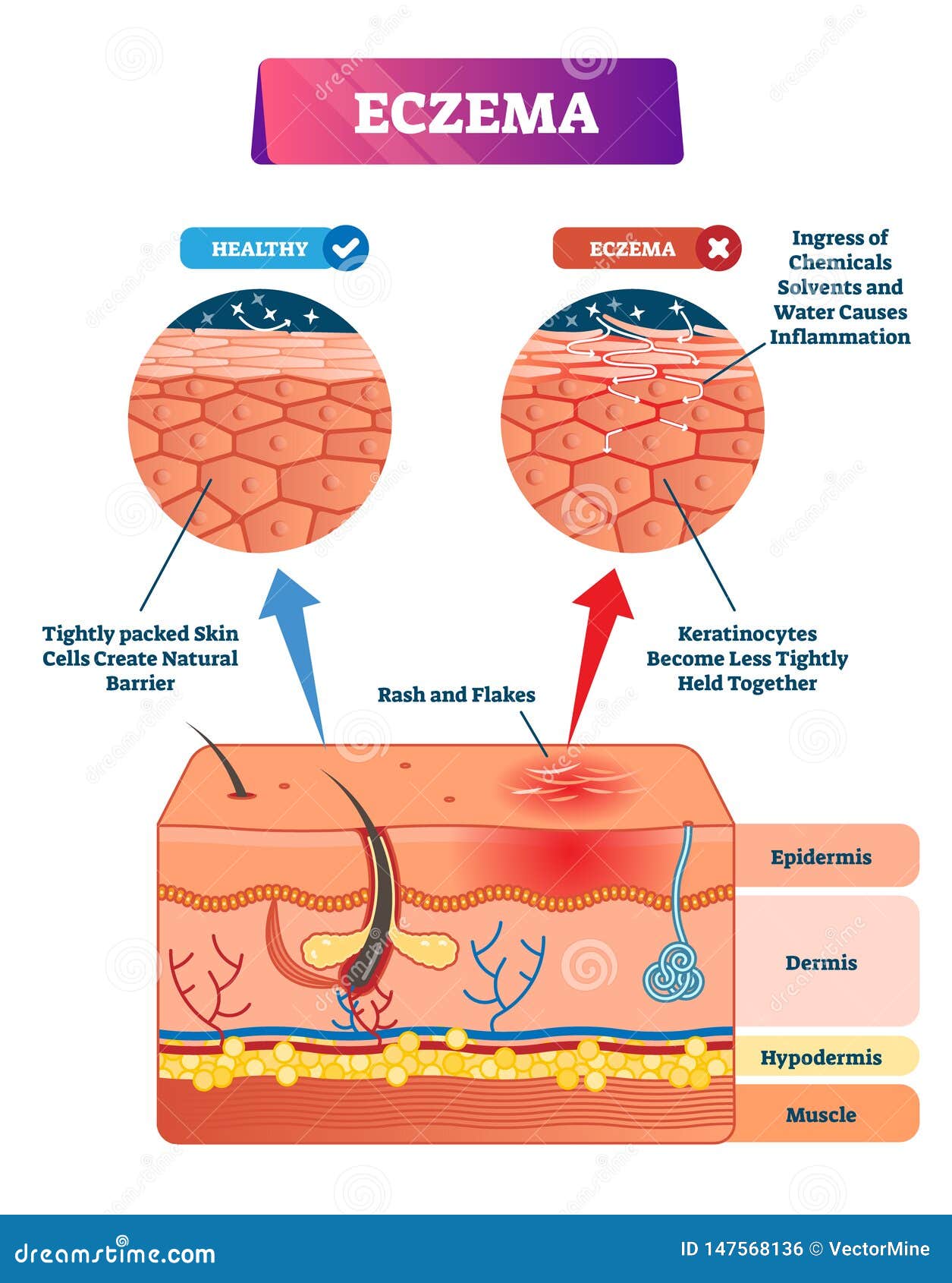 Eczema Vector Illustration. Labeled Anatomical Structure Comparative