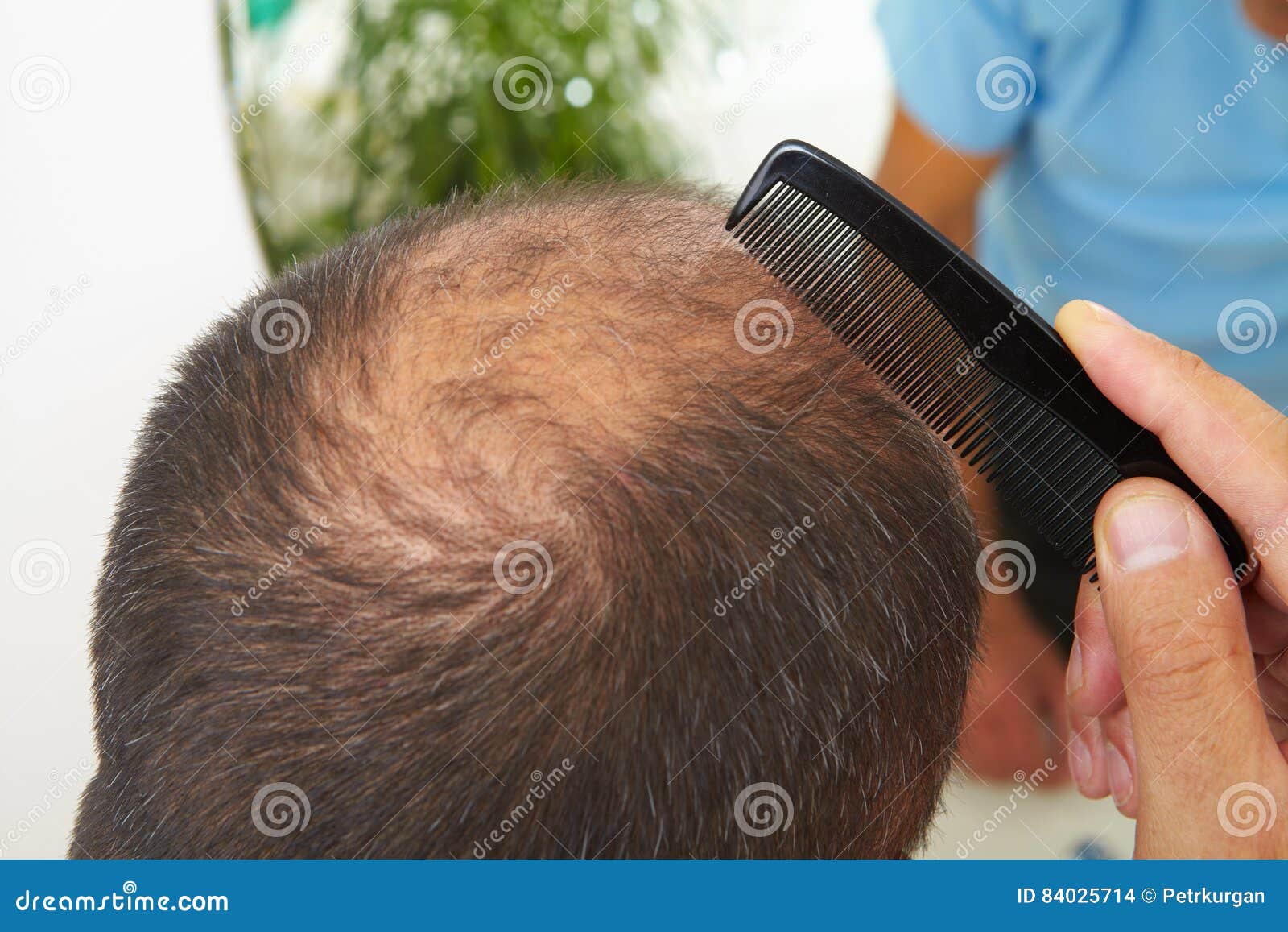 Edizione Di Perdita Di Capelli E Dell'uomo Senior ...