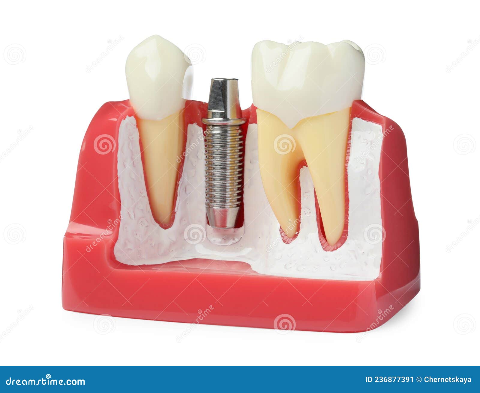Educational Model with Post and Abutment of Dental Implant between Teeth on White Background