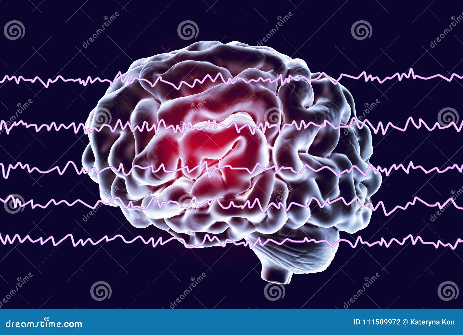 EEG Electroencephalogram, Brain Wave in Awake State with Mental ...