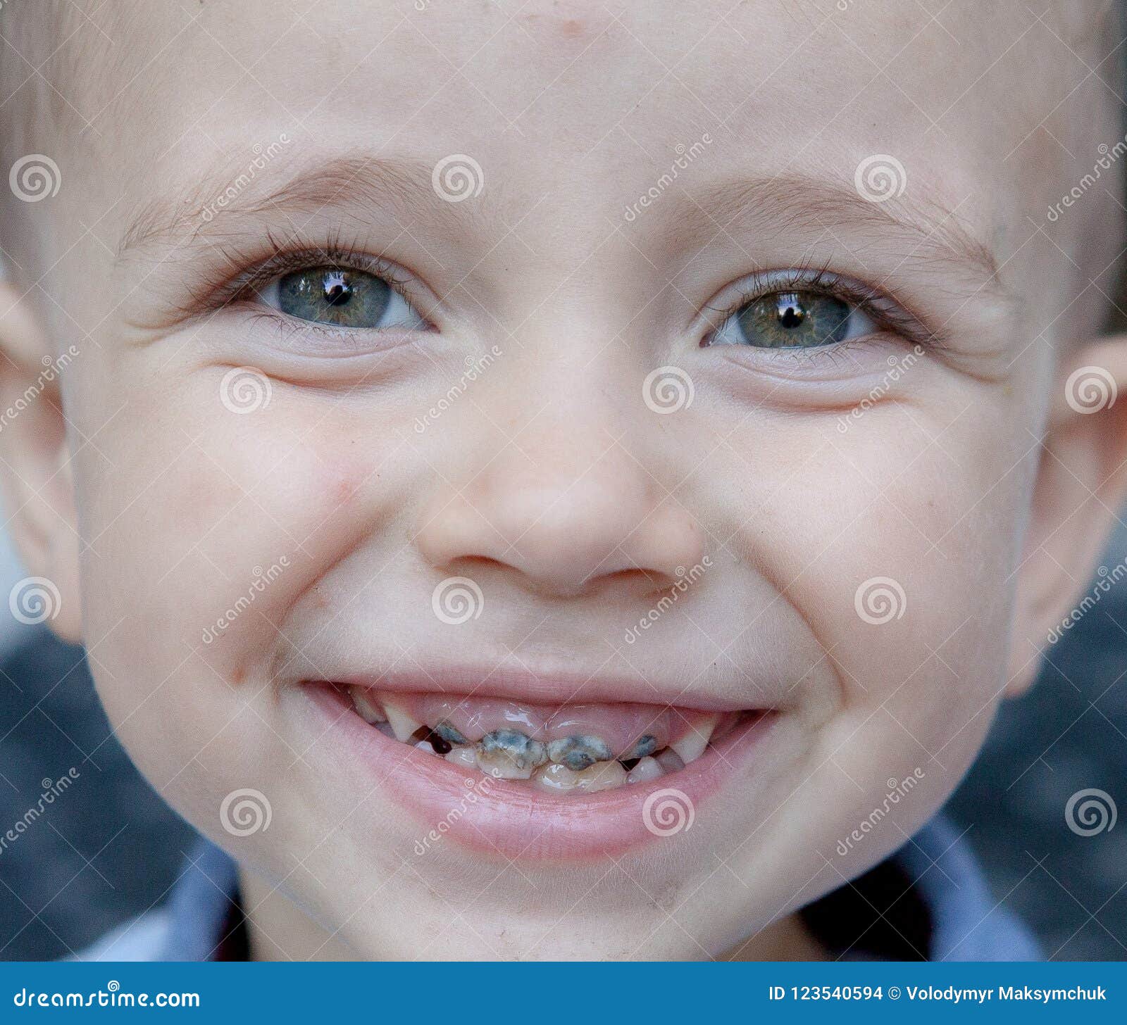 Een Kind Met Een Zwart Gat in Haar Tanden, Haar in Een Weinig Glimlachende Jongen Stock Foto - Image graaf, 123540594