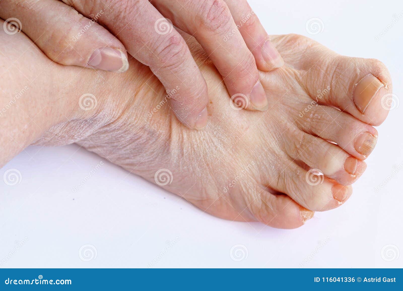 bevolking Scully Specialist Een Oudere Vrouw Heeft Jeukerige En Droge Huid Op Haar Handen En Voeten  Stock Foto - Image of gleuf, pijnlijk: 116041336