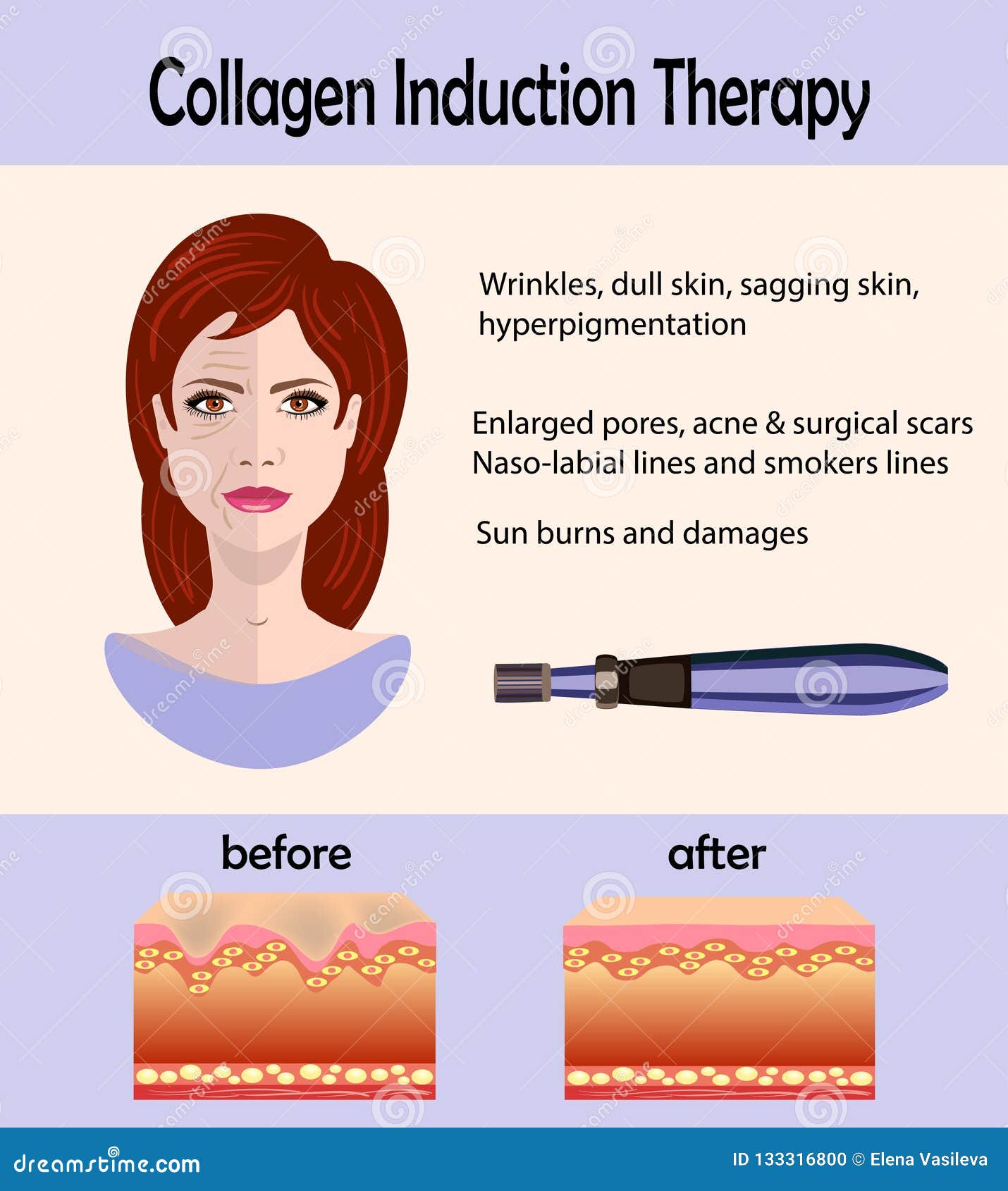before after effect, microneedle stamping device, collagen induction therapy