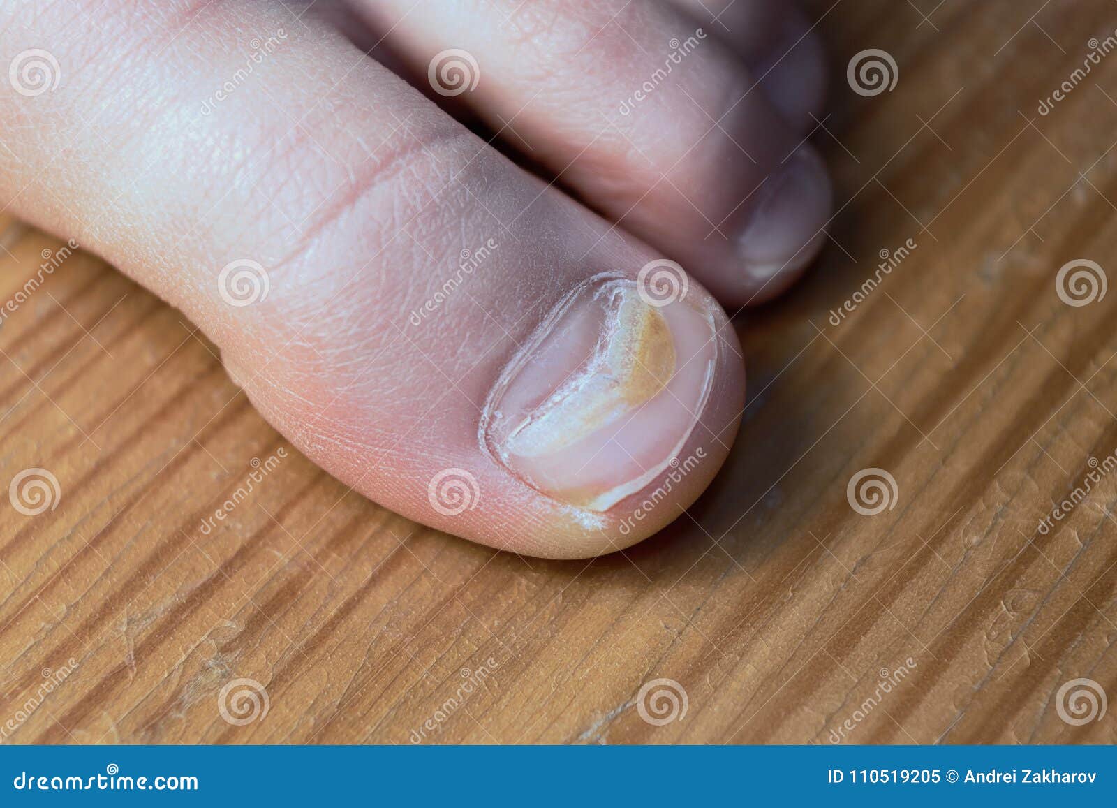 Effects of Enterovirus on the Body in the Form of Damage To the Thumb.  Stock Image - Image of human, growing: 110519205