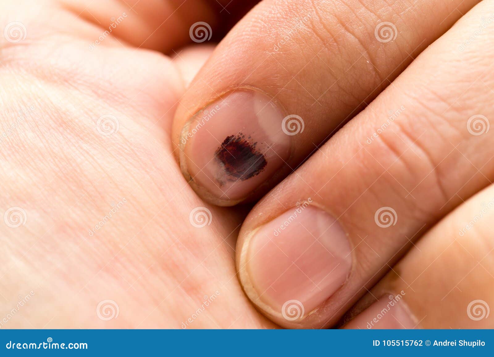 Blau nagel finger geklemmt Fingernagel