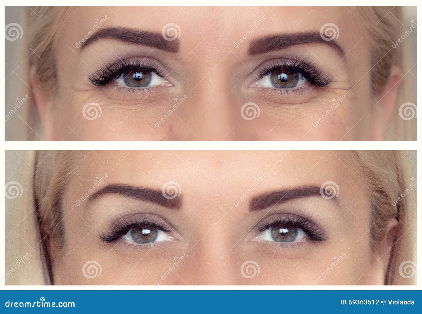 Einspritzungen Von Botox Vorher Und Nachher Stockfoto Bild von leute, heber 69363512