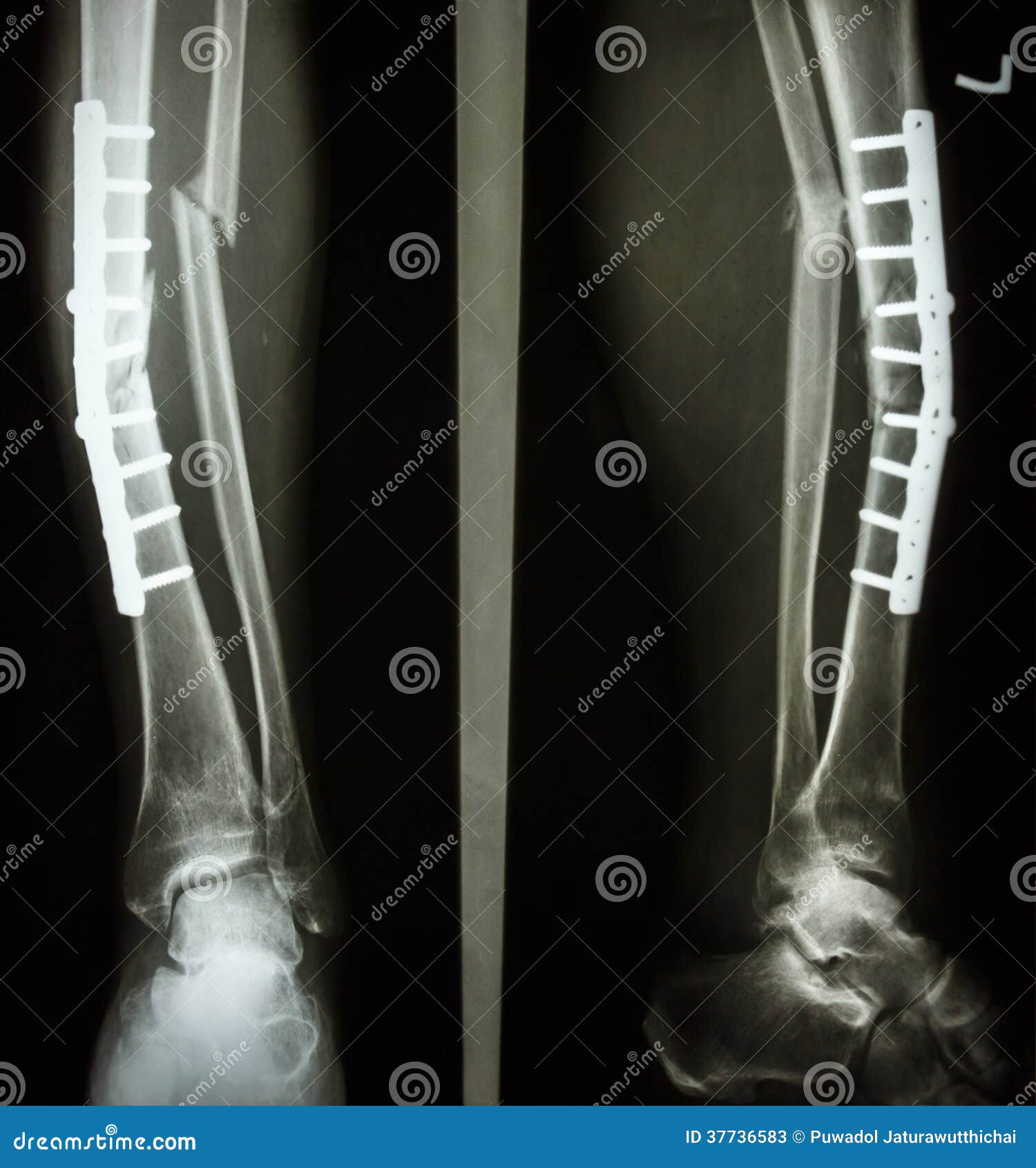 Eje De La Fractura De La Tibia Y Del Peroné Imagen De Archivo Imagen