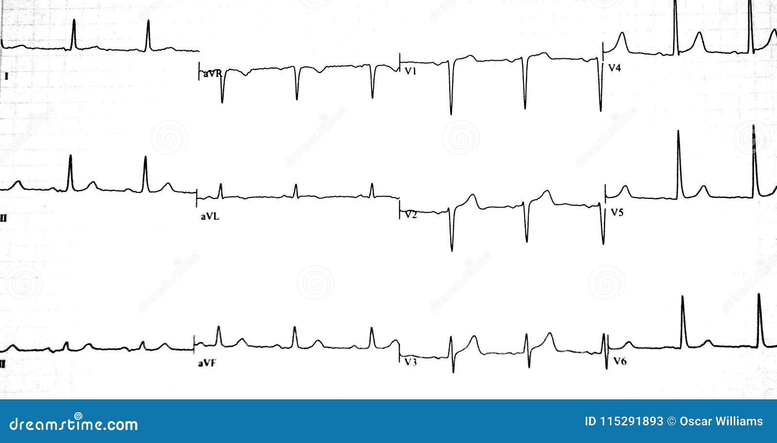 Ekg Chart