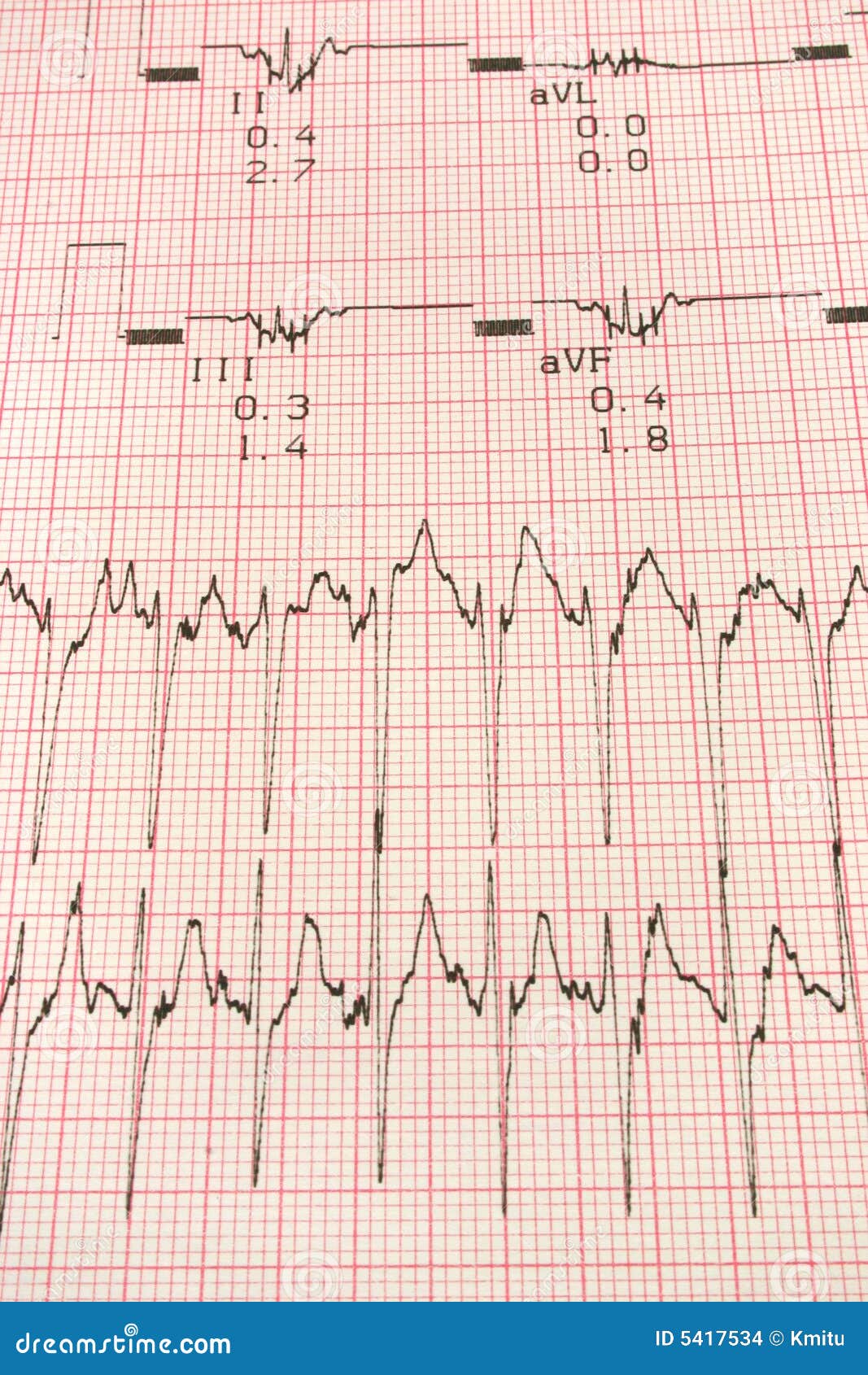 EKG Electrocardiology graph test results.