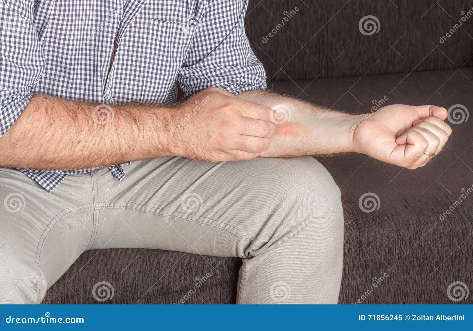 Ekzem, medizinisch stockbild. Bild von haut, ekzem, problem - 71856245