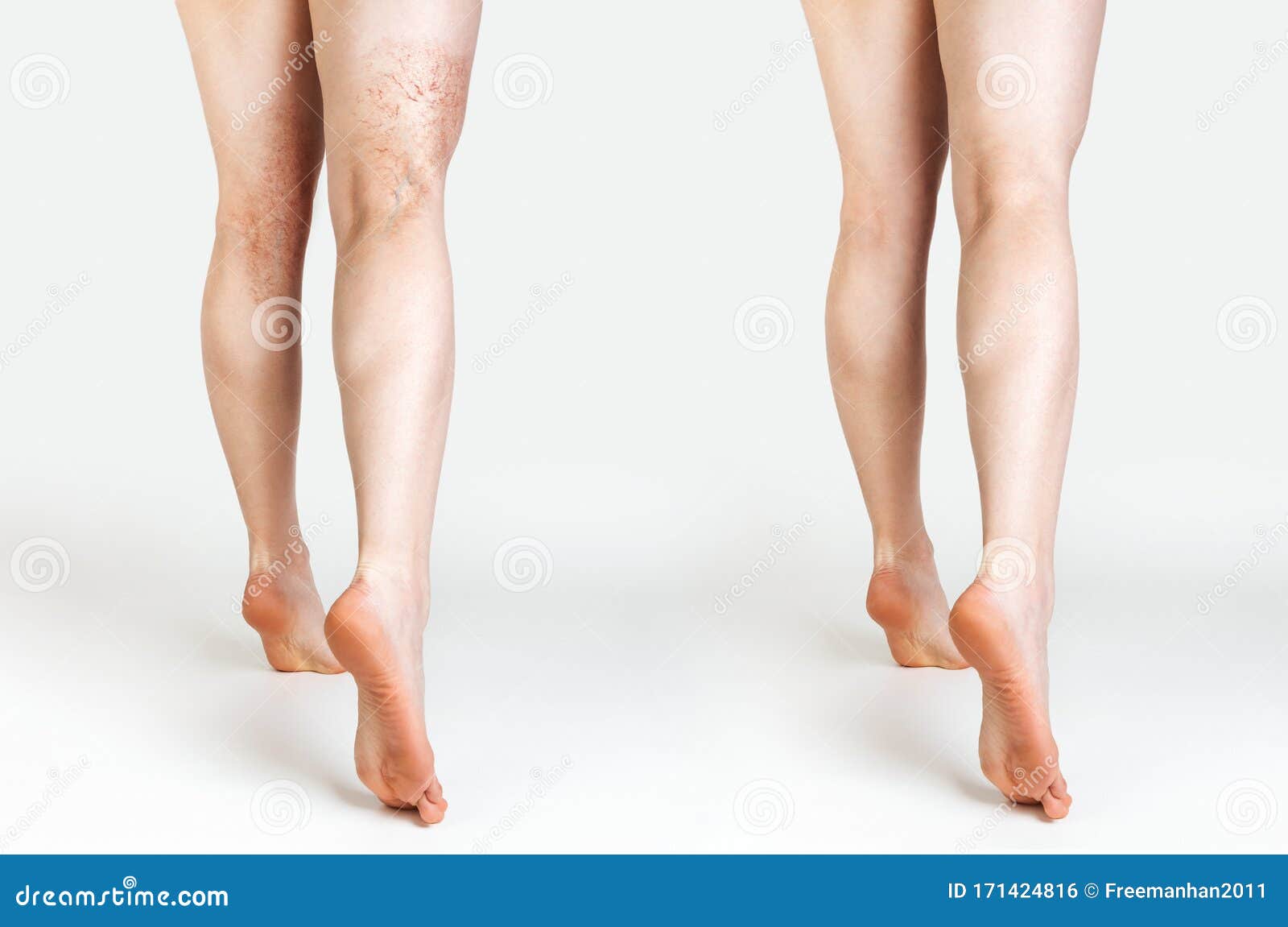 varicoza osteopatie