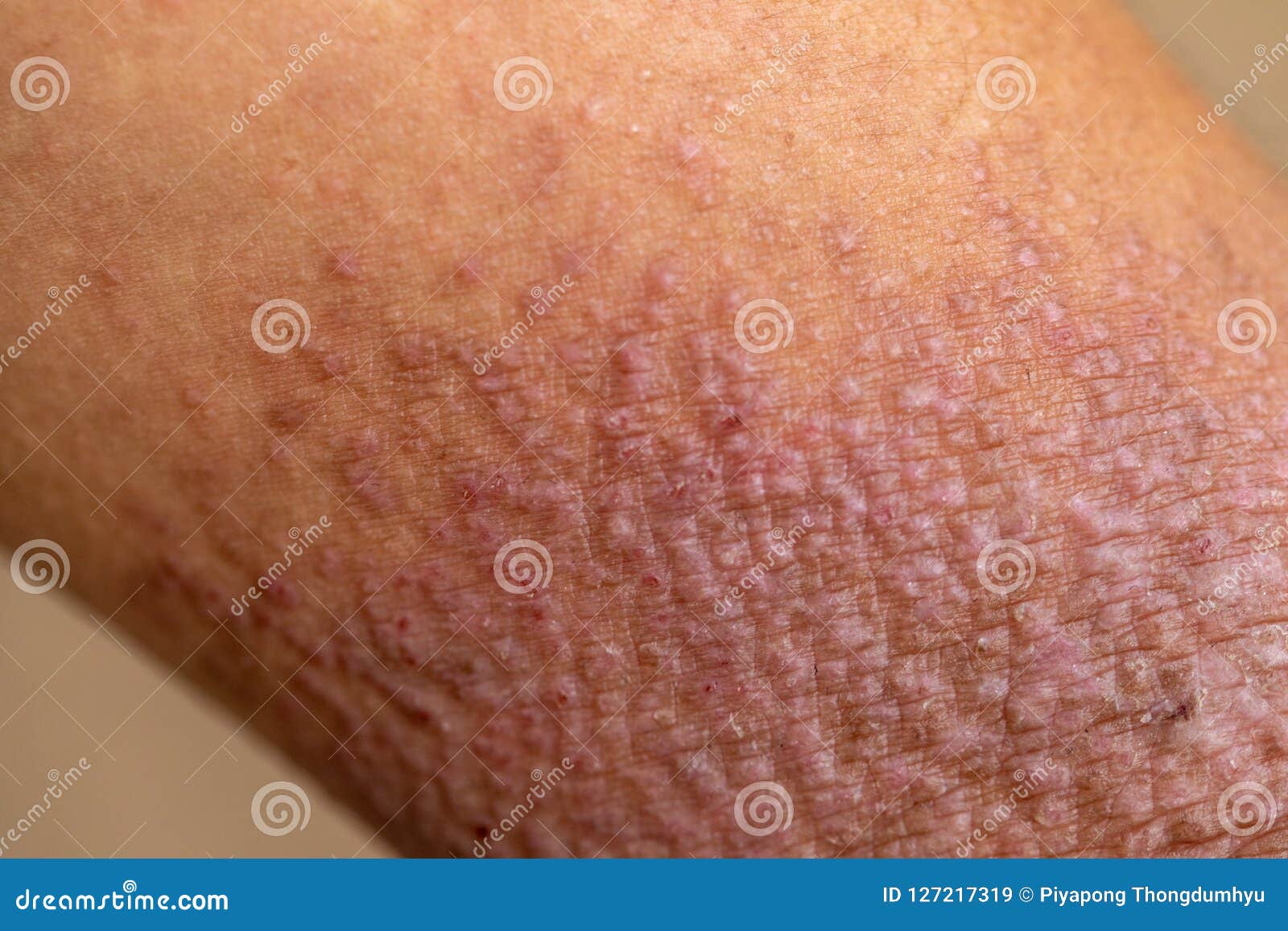 Defectuoso Criticar Uva El Estudio De La Comprobación Del ANUNCIO Del Dermatitis Atópico, También  Conocida Como Eczema Atópico, Es Un Tipo De Inflamación Imagen de archivo -  Imagen de problema, médico: 127217319