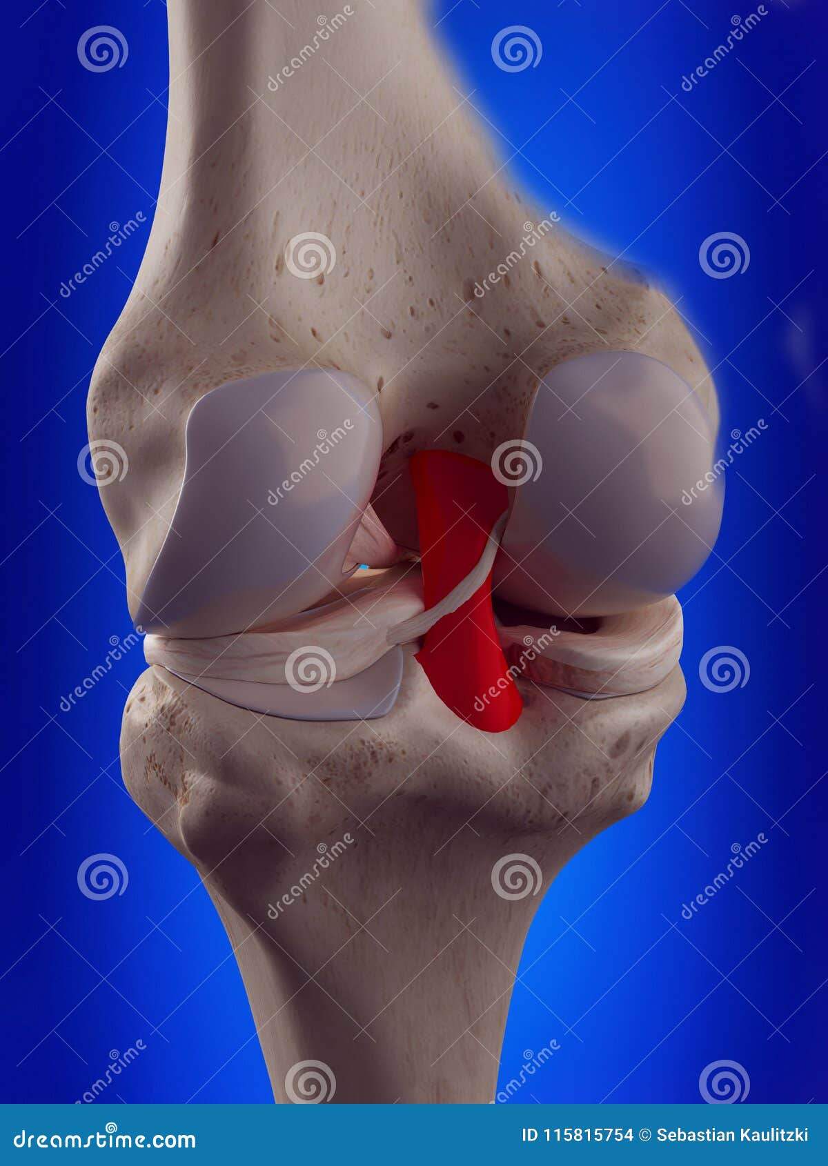 La lesión del ligamento cruzado posterior (LCP) ocurre por un impacto  directo en la parte frontal de la rodilla o por hiperextensión. Puede  causar dolor, hinchazón e inestabilidad. El tratamiento varía desde, image size:1200x1690
