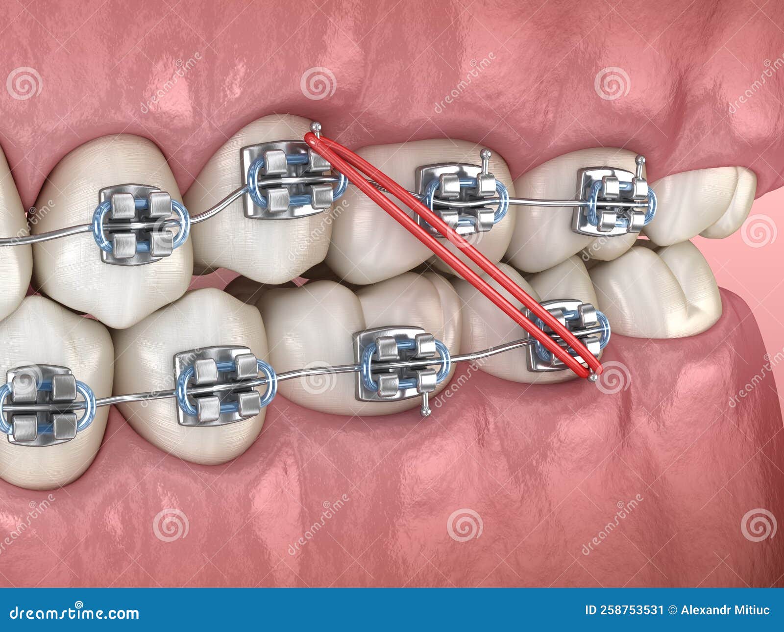 283 Braces Rubber Bands Stock Photos - Free & Royalty-Free Stock Photos  from Dreamstime