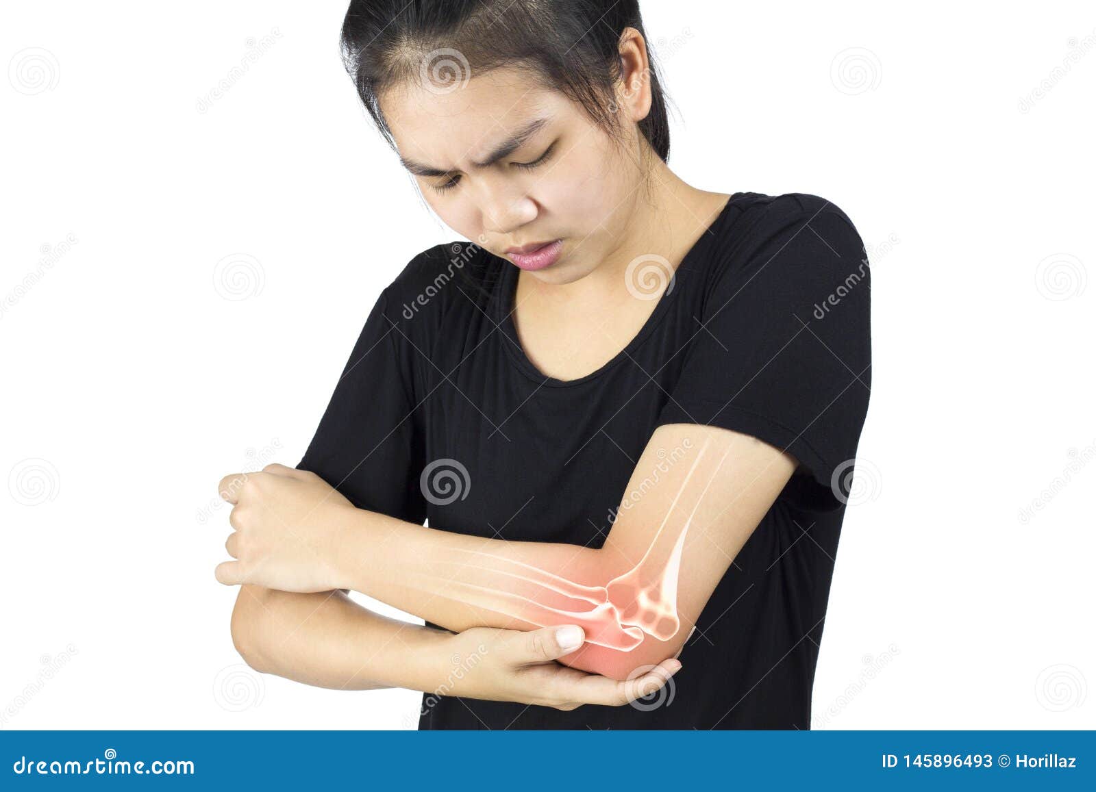 Elbow bones injury stock image. Image of injury, numbness 145896493