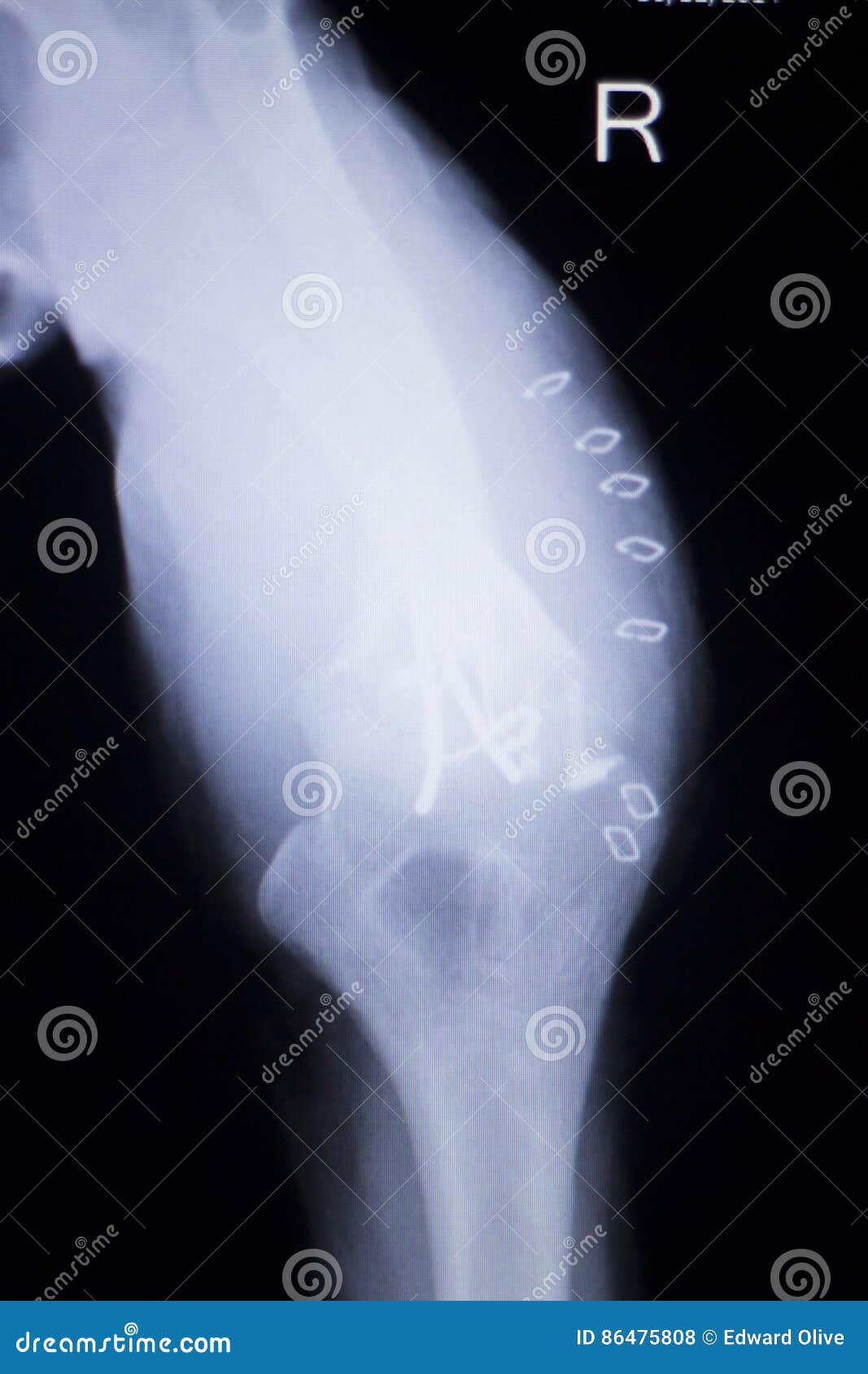 elbow joint implant xray stock photo image of orthopedics elbow xray