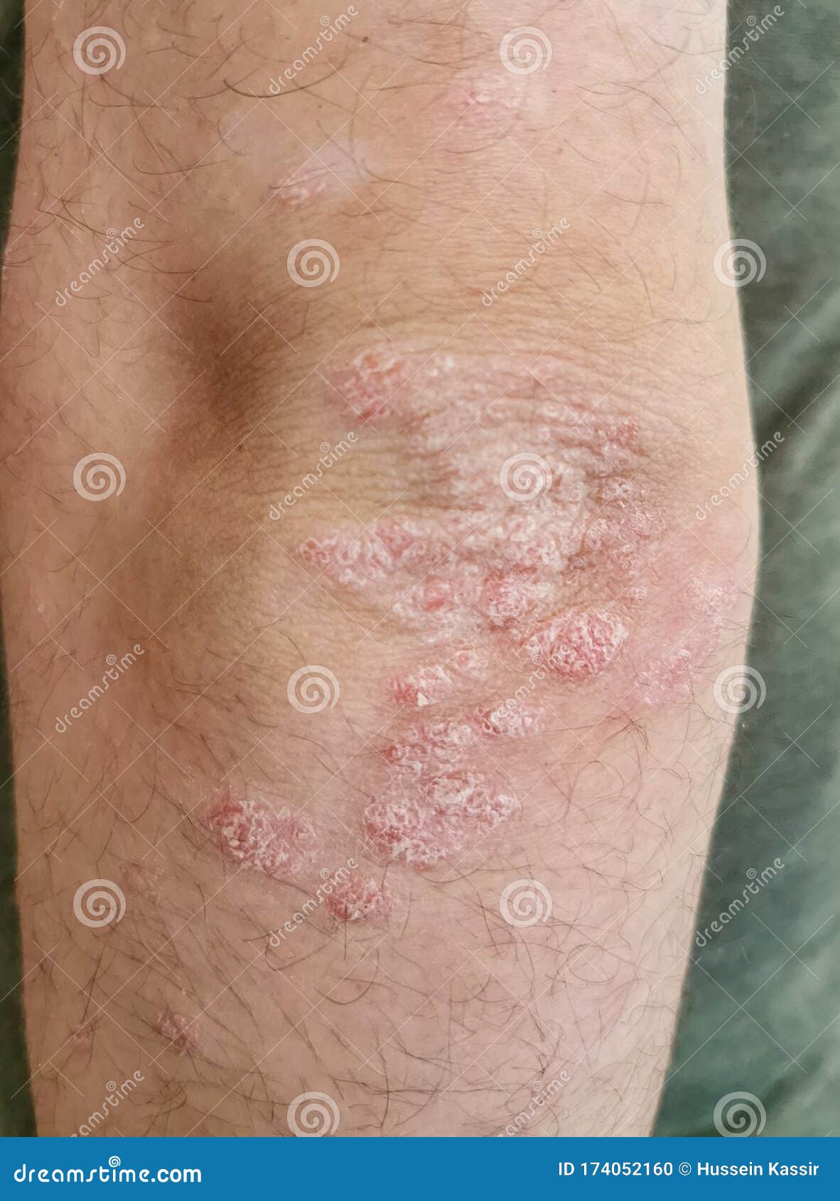 Skin With Psoriasis Stock Photo 18964878