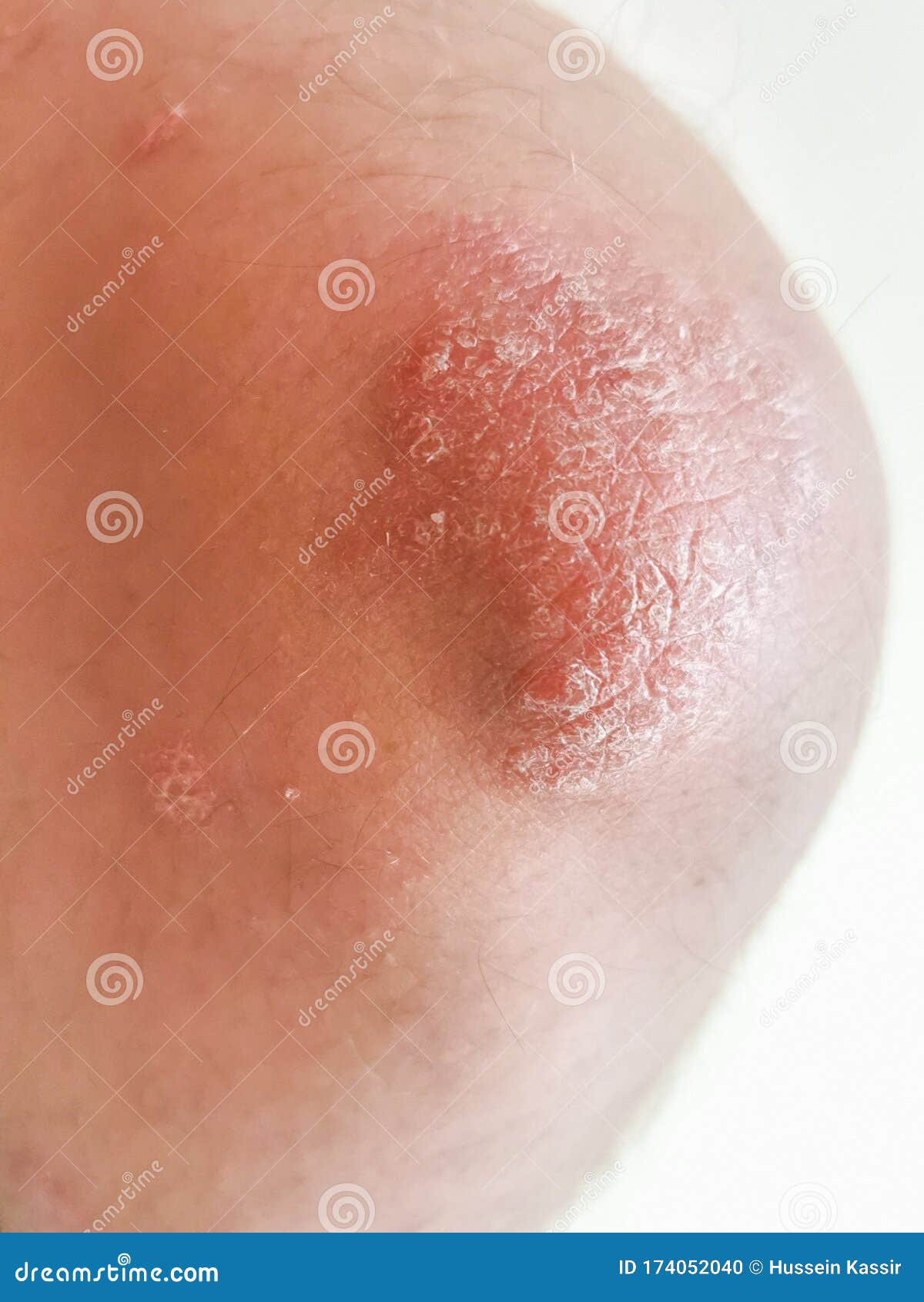 Elbow Skin Psoriasis Disease Problem Stock Photo Image Of Dermatitis
