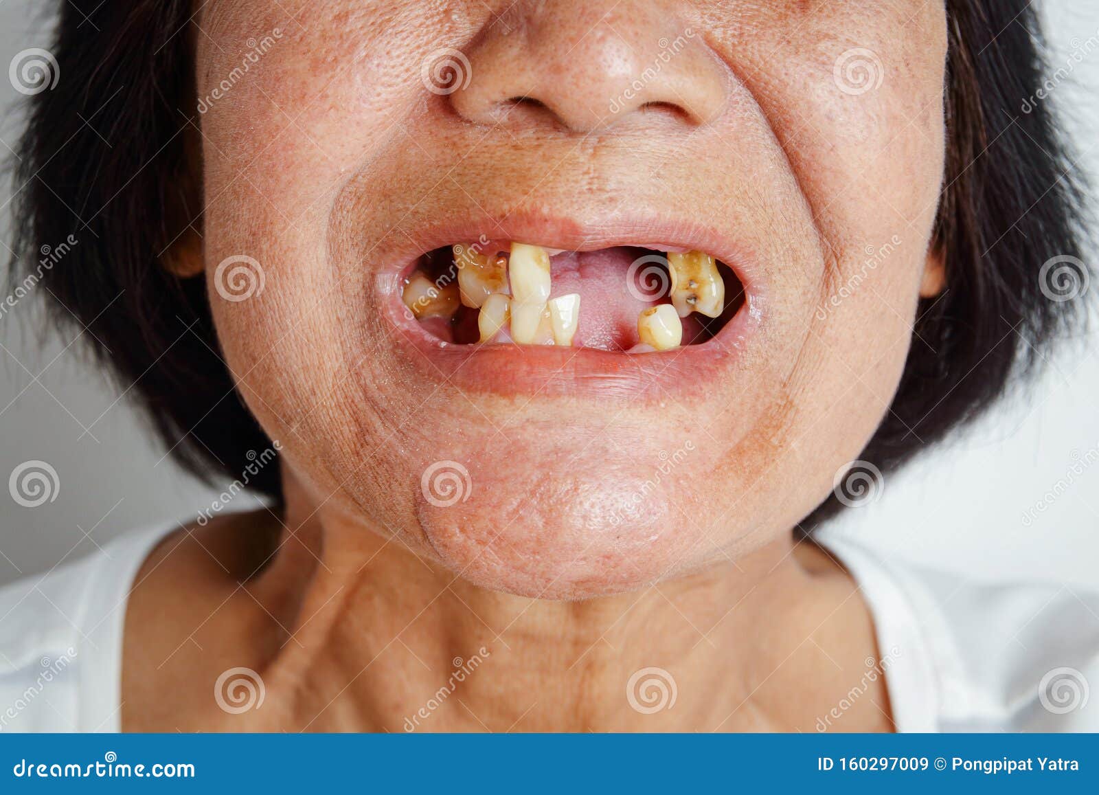 Woman with rotten teeth