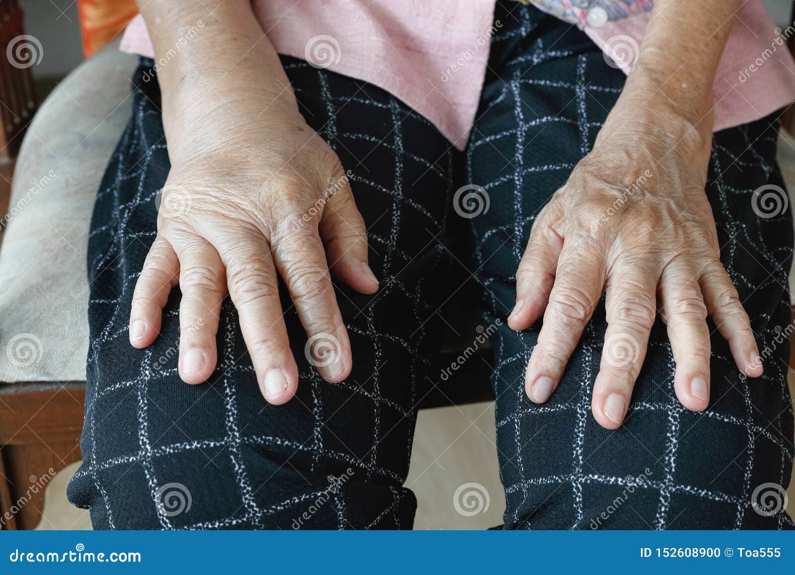 elderly swollen hand or edema hand