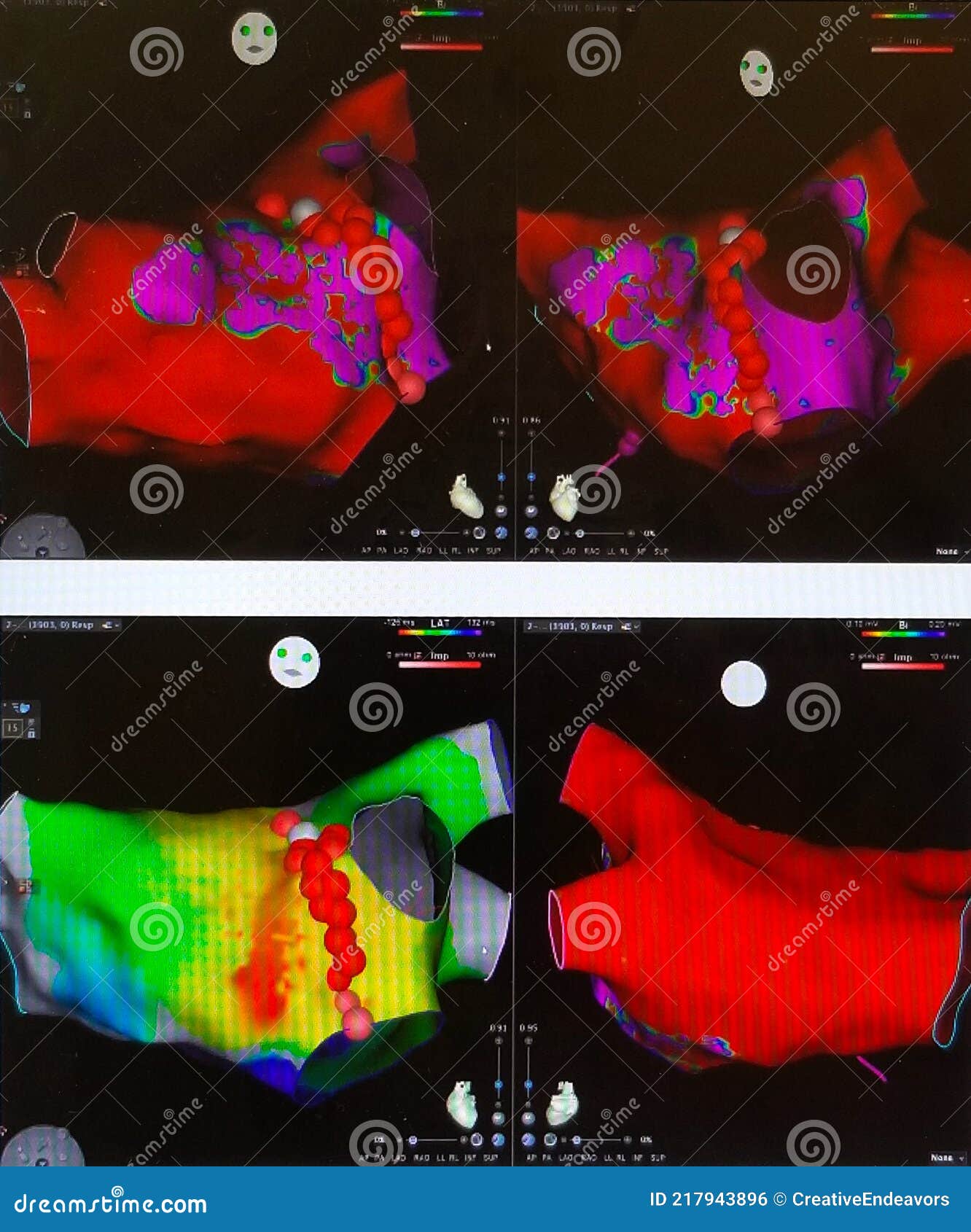 electrical mapping of the left atrium - radiofrequency ablation for svt
