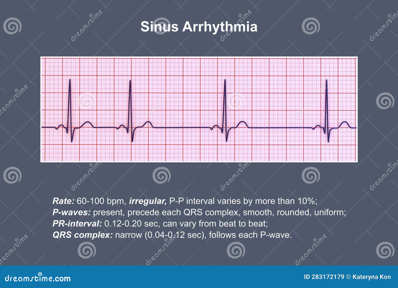 Sinus Arrhythmia supraventricular-clipart-and-illustrations