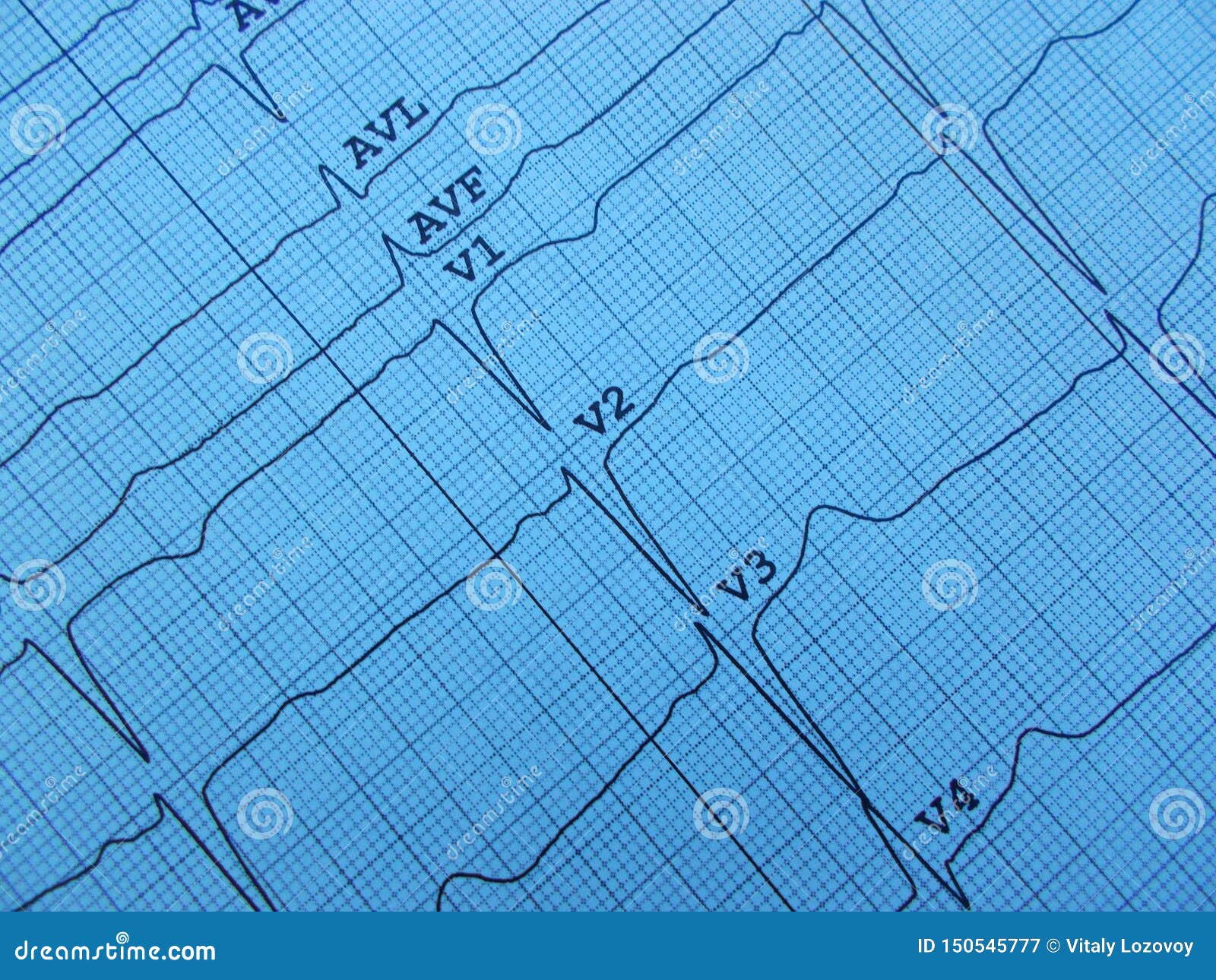 normal cardiograph normal cardiograph