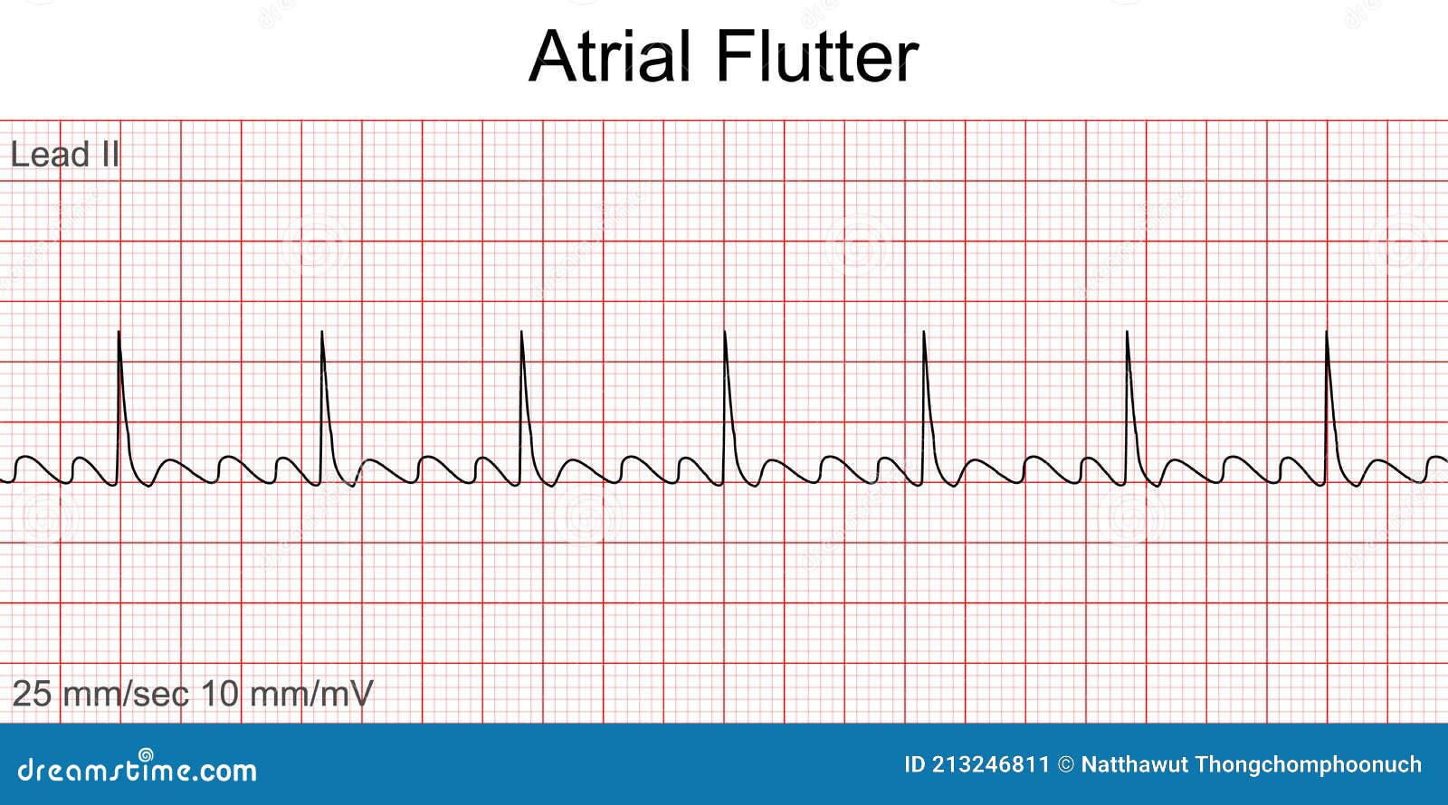 electrocardiogram show atrial flutter pattern.