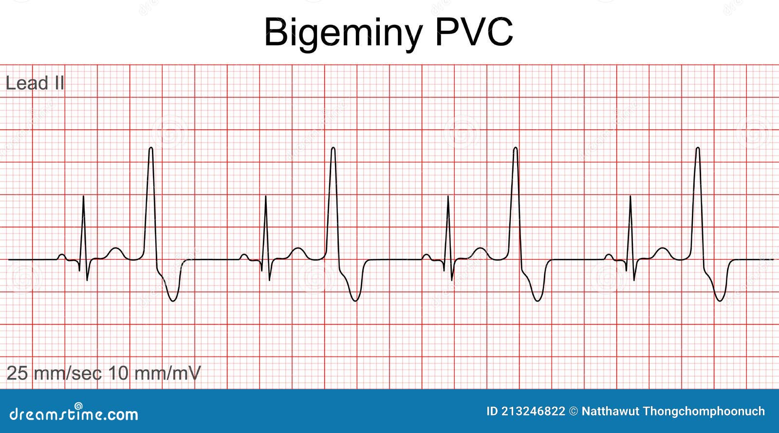 PVC EKG Image