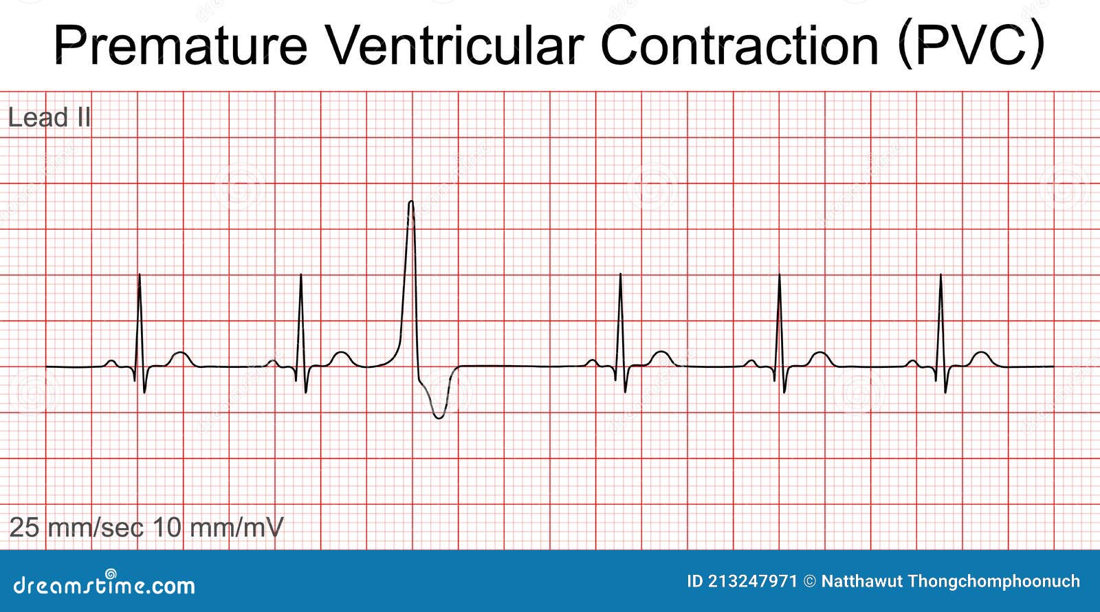 Electrocardiogram Show Sinus Tachycardia Pattern Vector Illustration