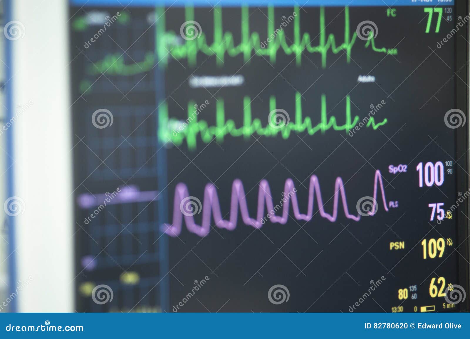 definition of cardiograph definition of cardiograph