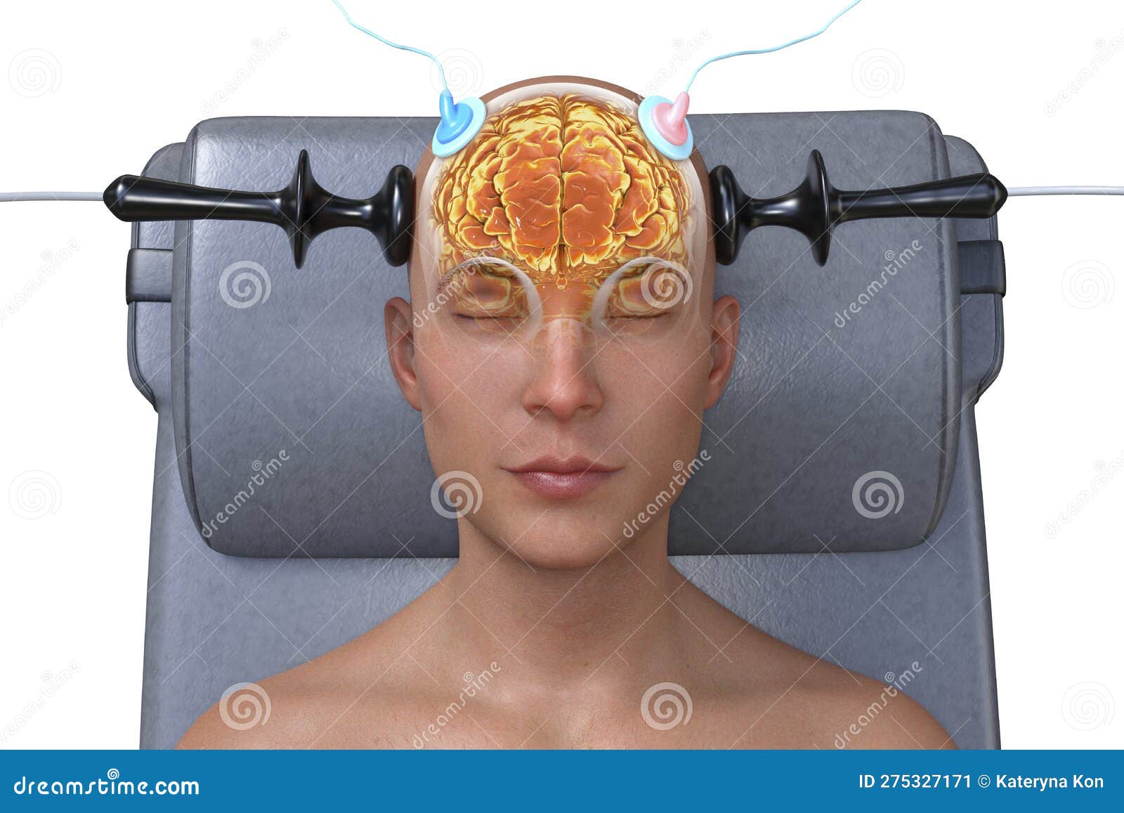 Electroconvulsive Therapy, ECT, a Treatment Involving the Use of